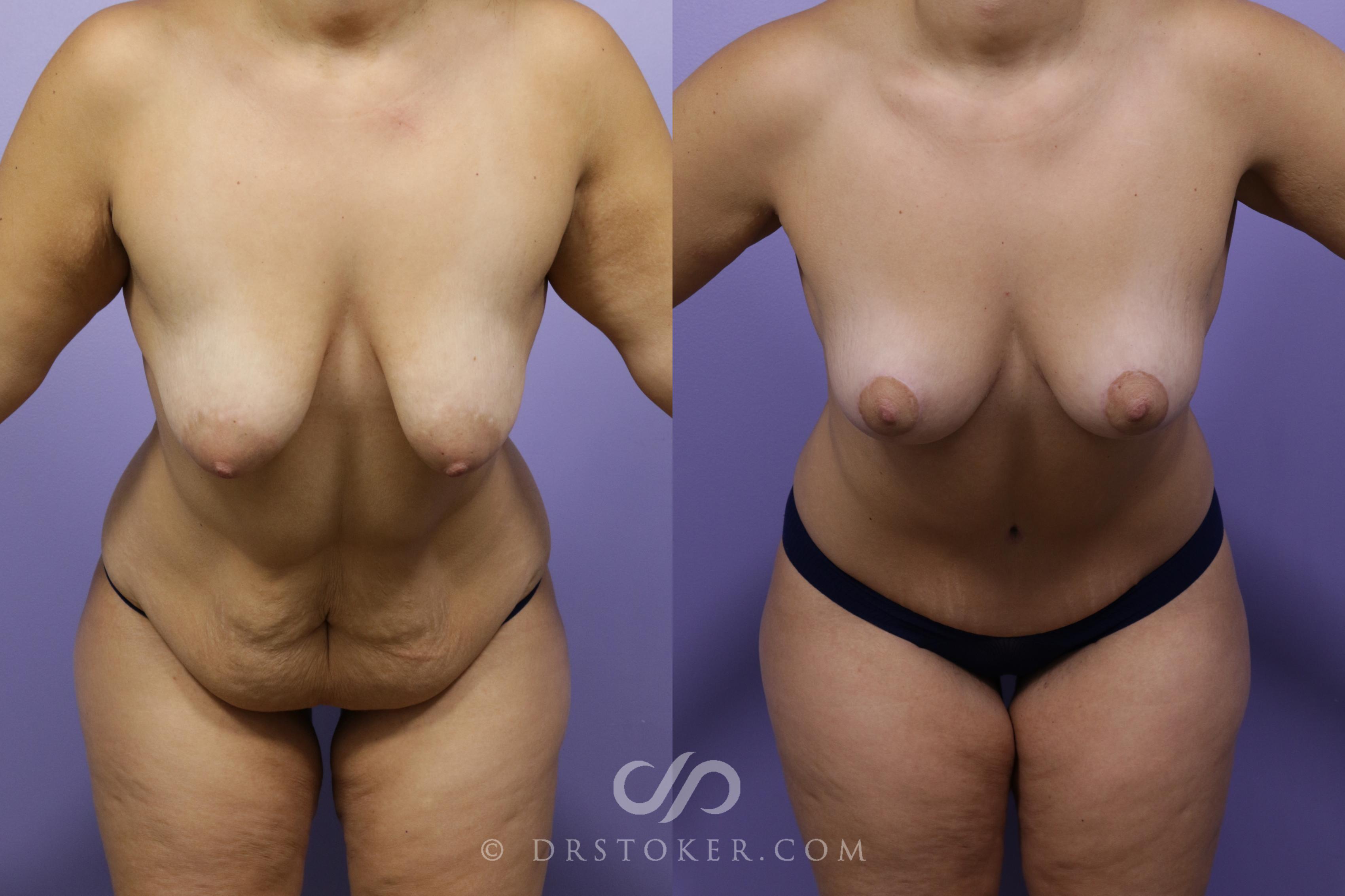 Before & After After Weight Loss Case 1740 View #1 View in Los Angeles, CA