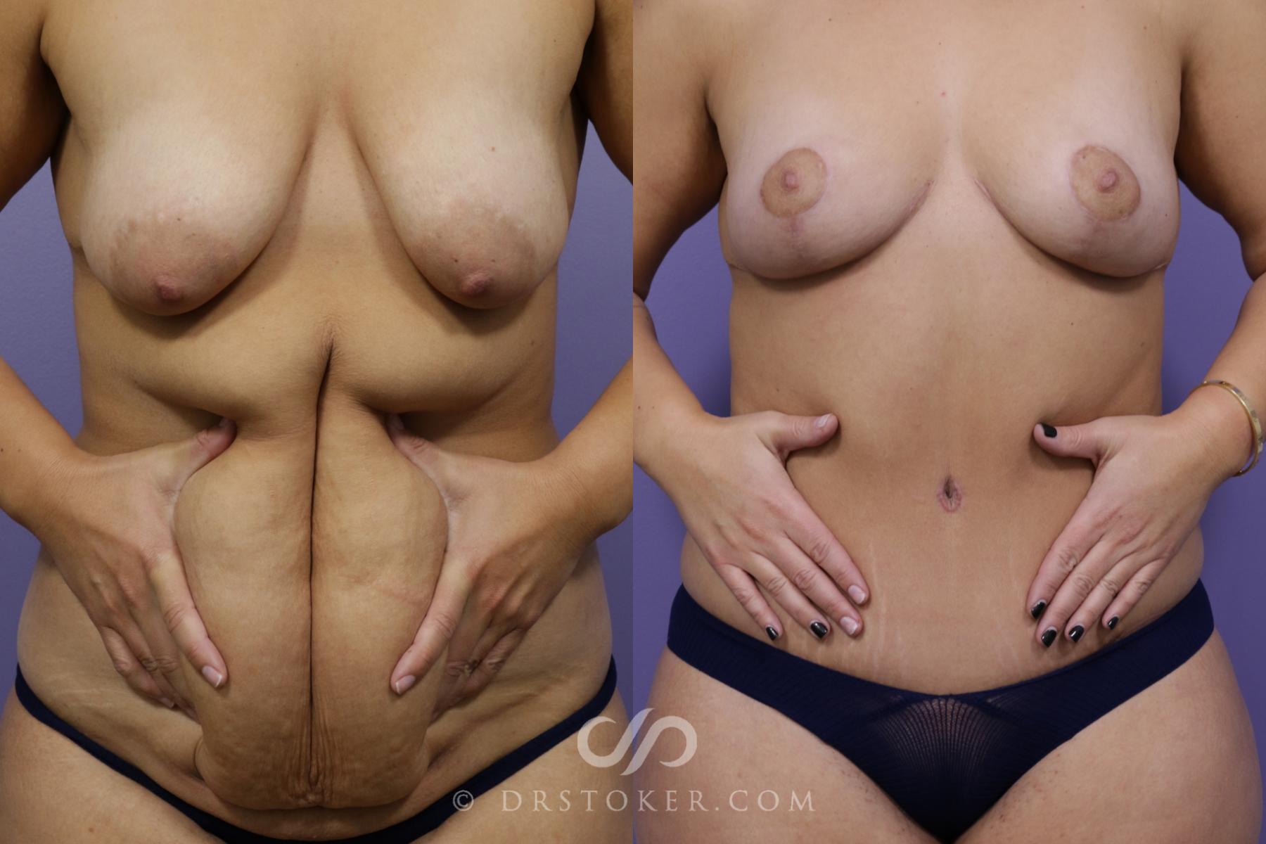 Before & After After Weight Loss Case 1740 View #2 View in Los Angeles, CA