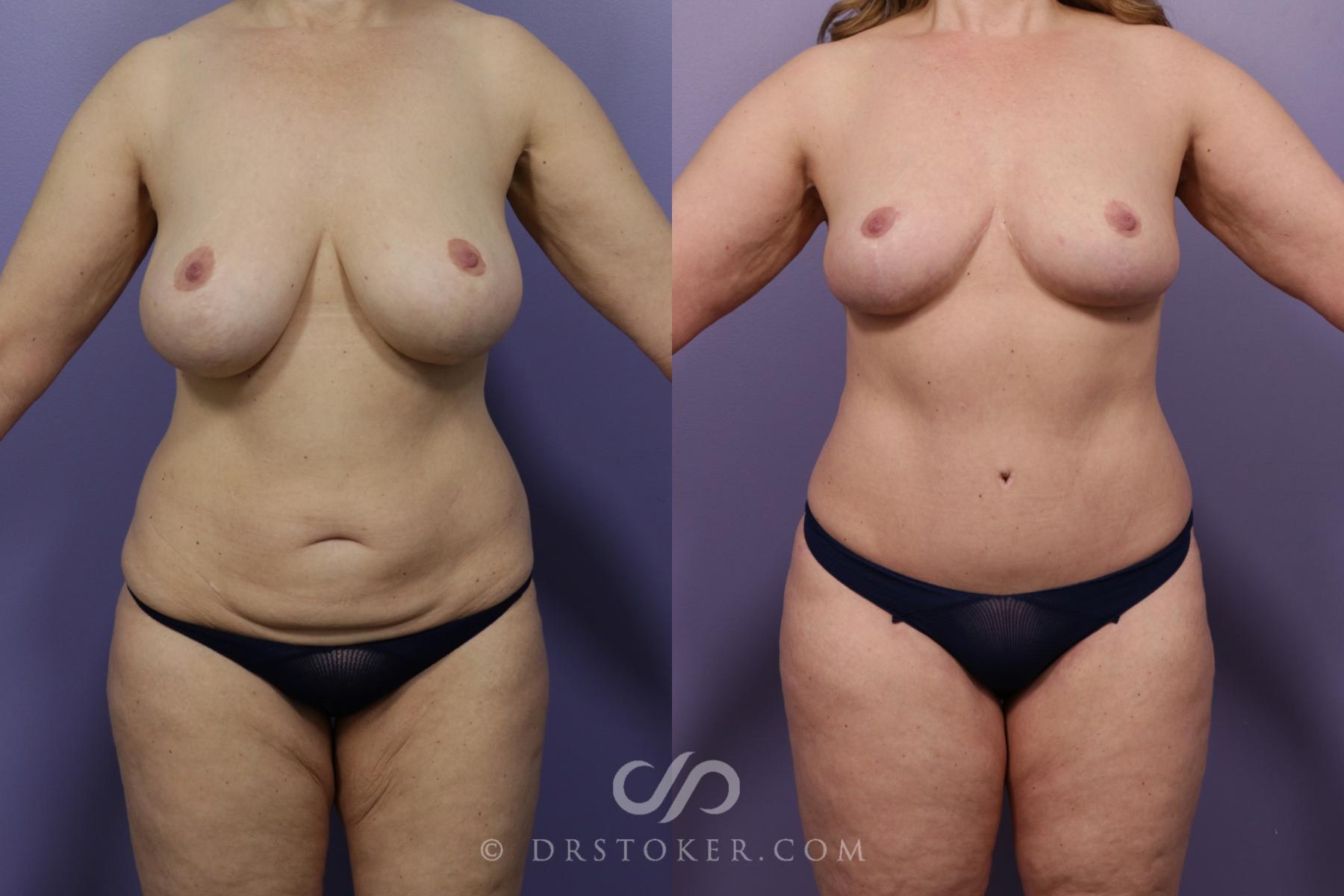 Before & After After Weight Loss Case 1758 View #1 View in Los Angeles, CA