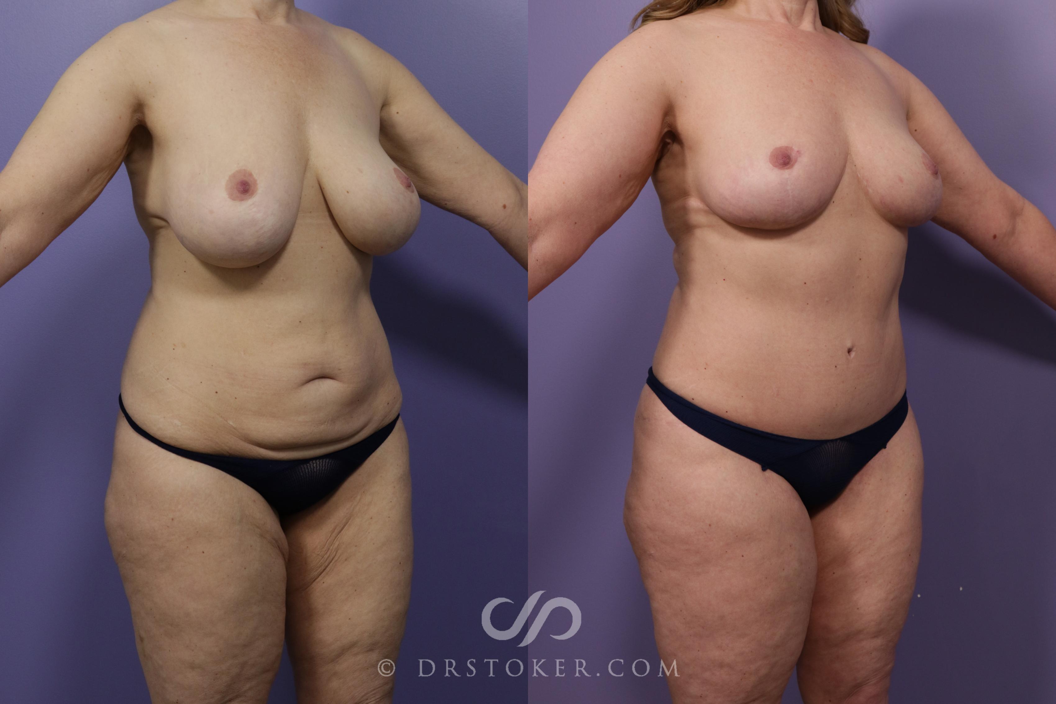 Before & After Mommy Makeover Case 1758 View #2 View in Los Angeles, CA