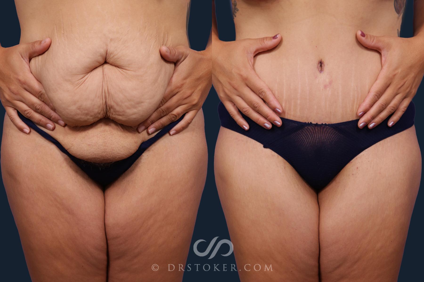 Before & After Tummy Tuck Case 2028 Front View in Los Angeles, CA