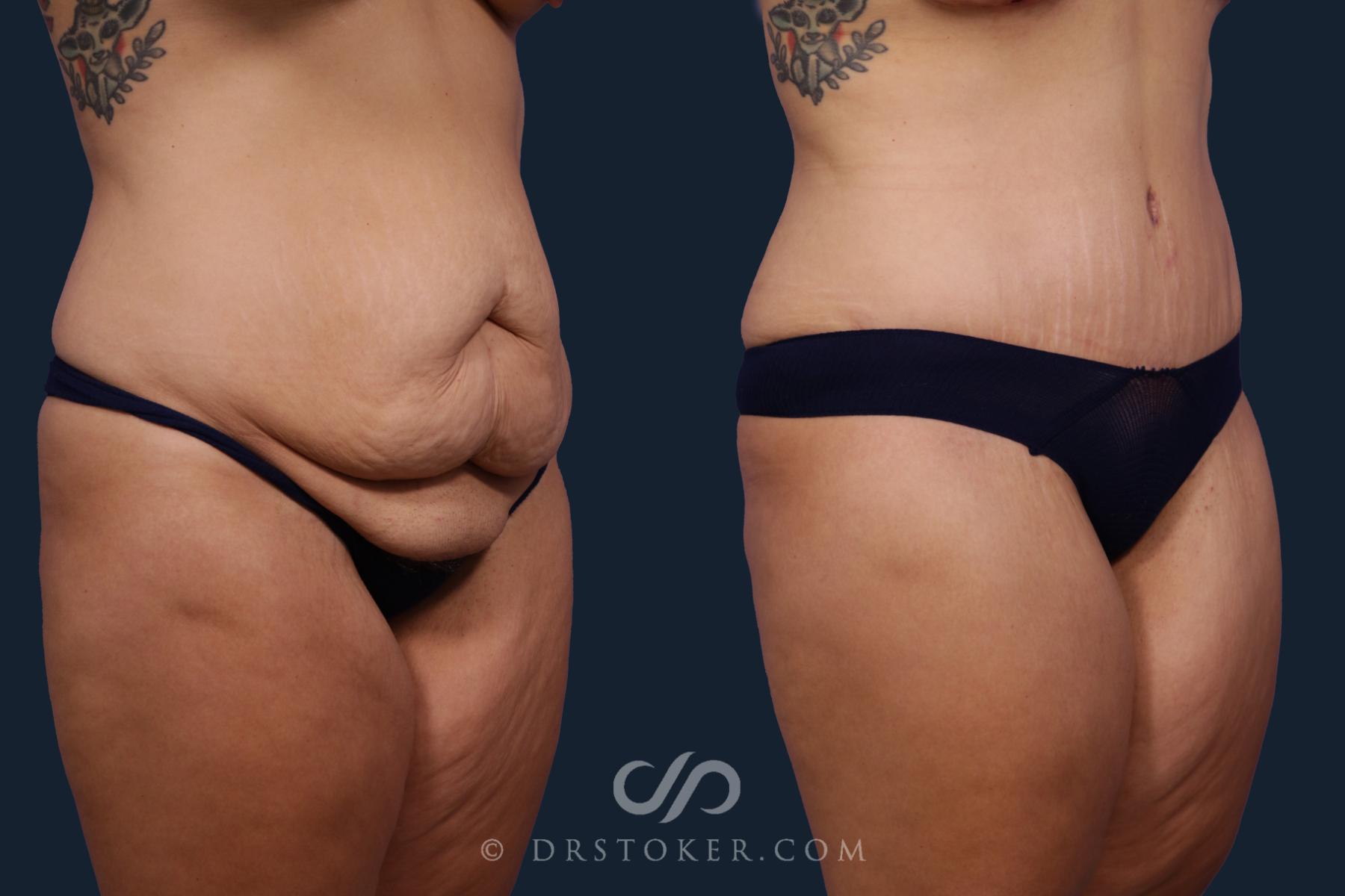 Before & After Tummy Tuck Case 2028 Left Oblique View in Los Angeles, CA