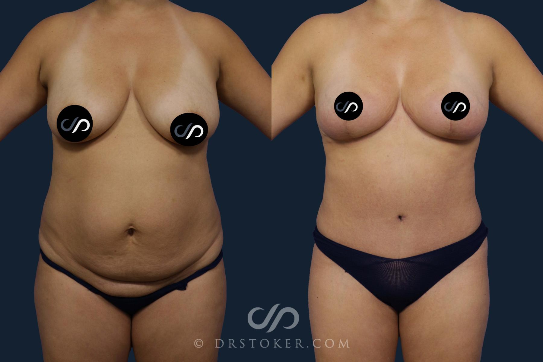 Before & After Tummy Tuck Case 2053 Front View in Los Angeles, CA
