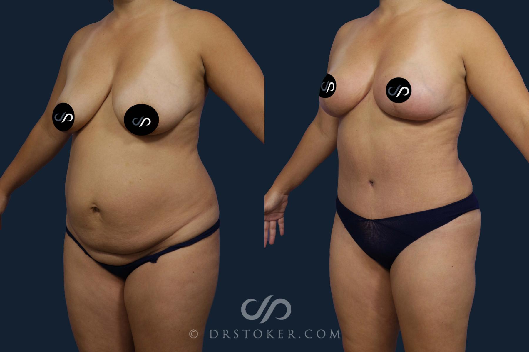 Before & After Tummy Tuck Case 2053 Left Oblique View in Los Angeles, CA