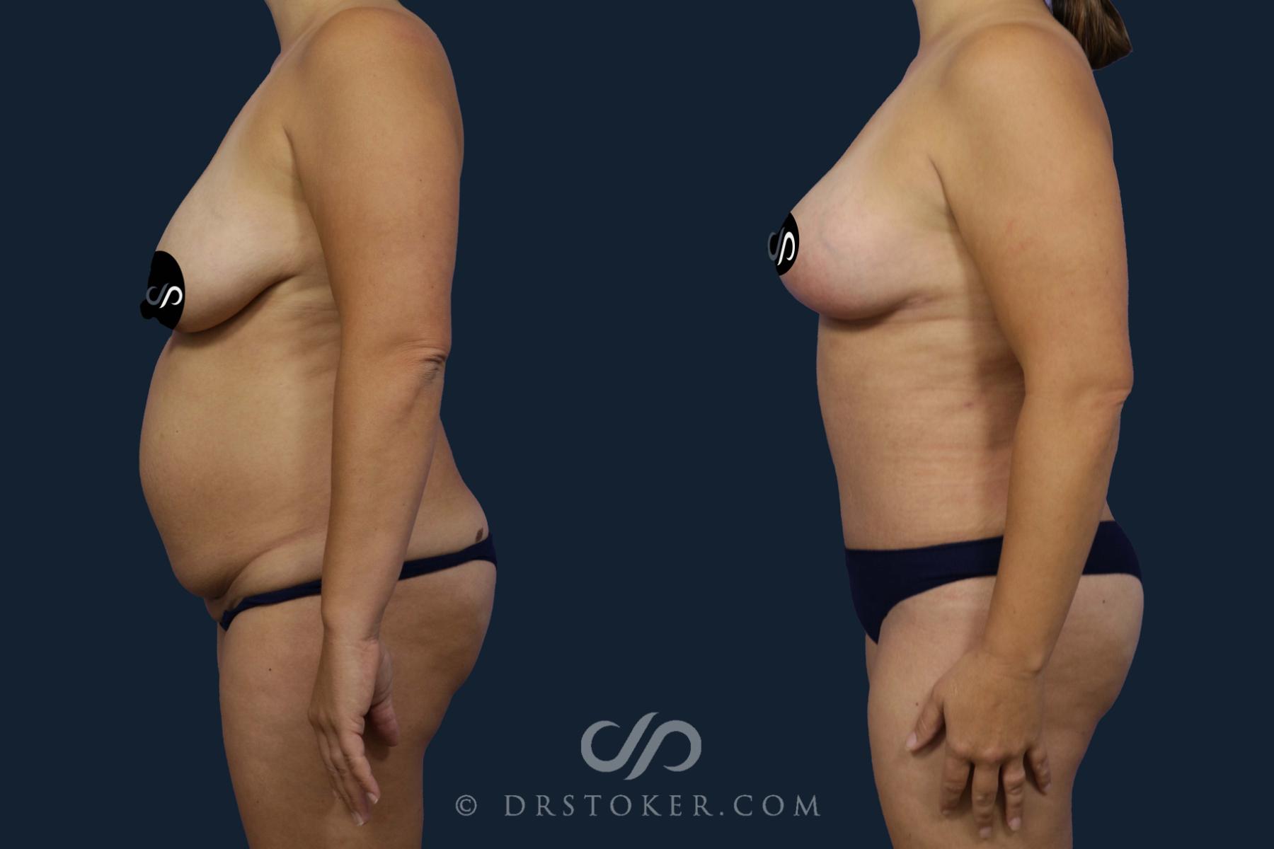 Before & After Tummy Tuck Case 2053 Left Side View in Los Angeles, CA