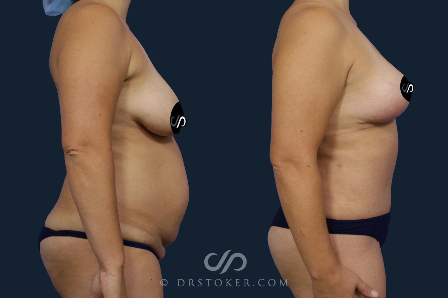 Before & After Tummy Tuck Case 2053 Right Side View in Los Angeles, CA