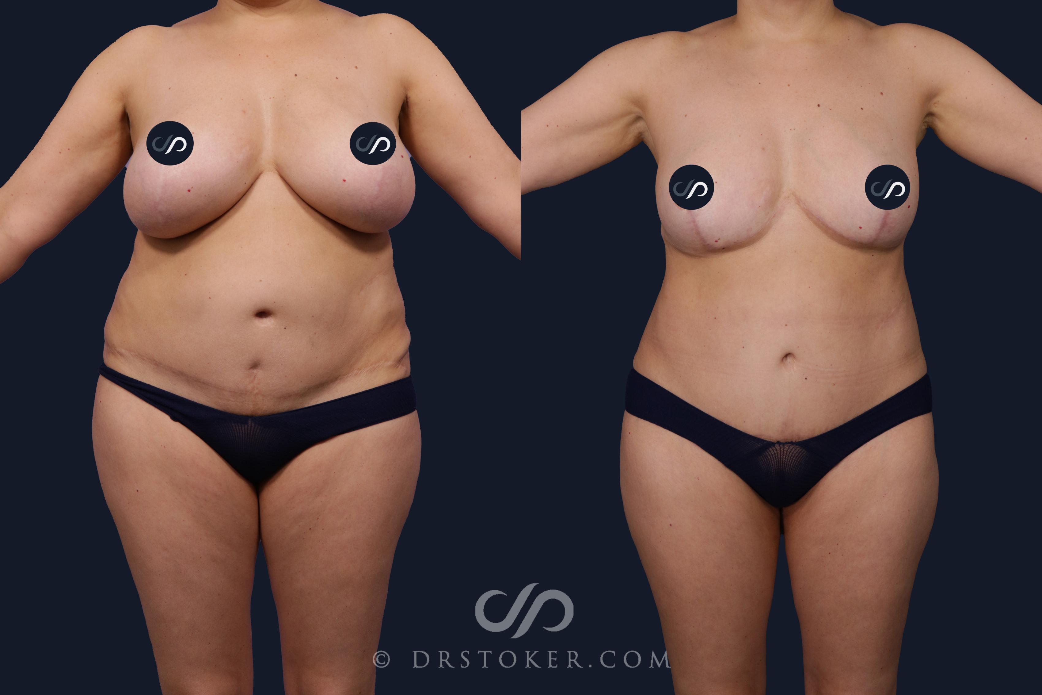 Before & After Tummy Tuck Case 2061 Front View in Los Angeles, CA