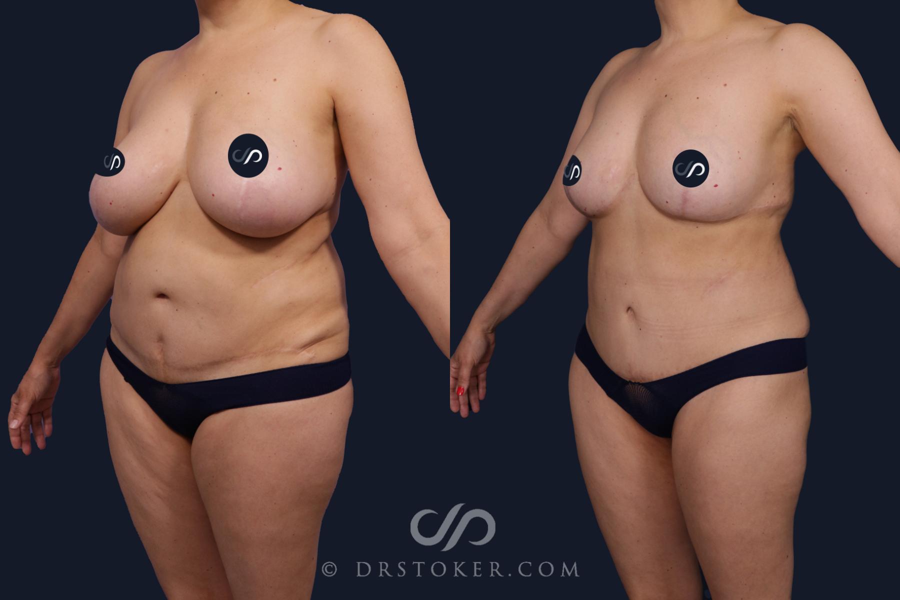 Before & After Tummy Tuck Case 2061 Left Oblique View in Los Angeles, CA