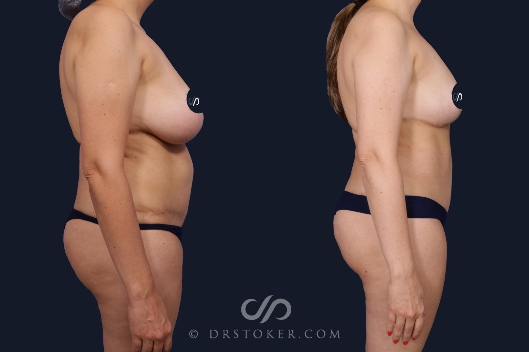 Before & After Tummy Tuck Case 2061 Right Side View in Los Angeles, CA