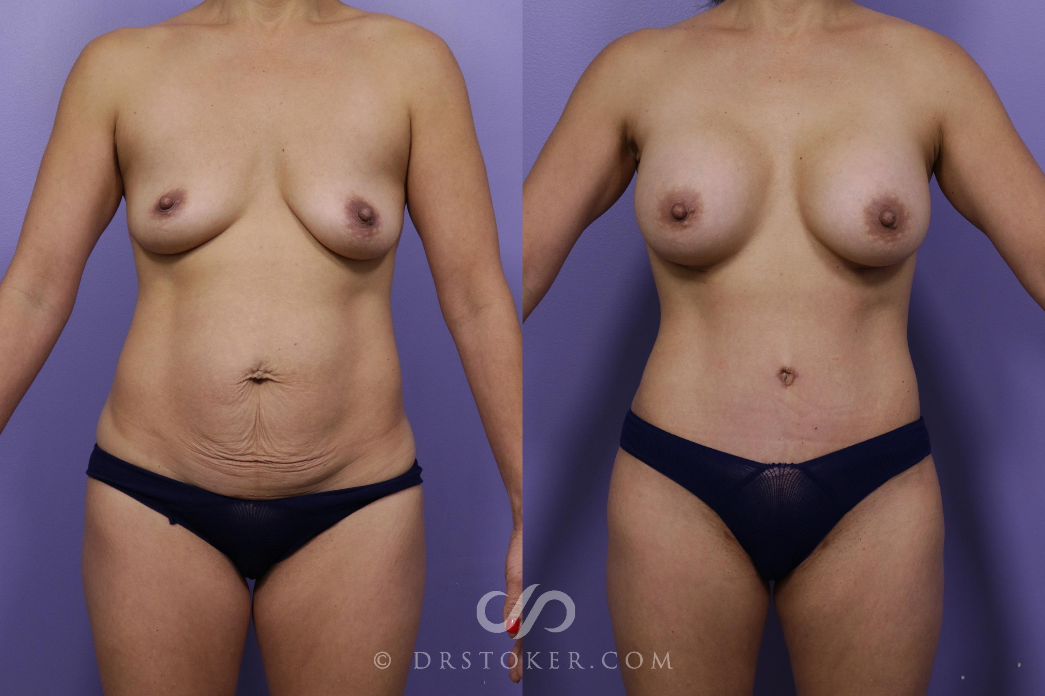 Before & After Tummy Tuck Case 2081 Front View in Los Angeles, CA