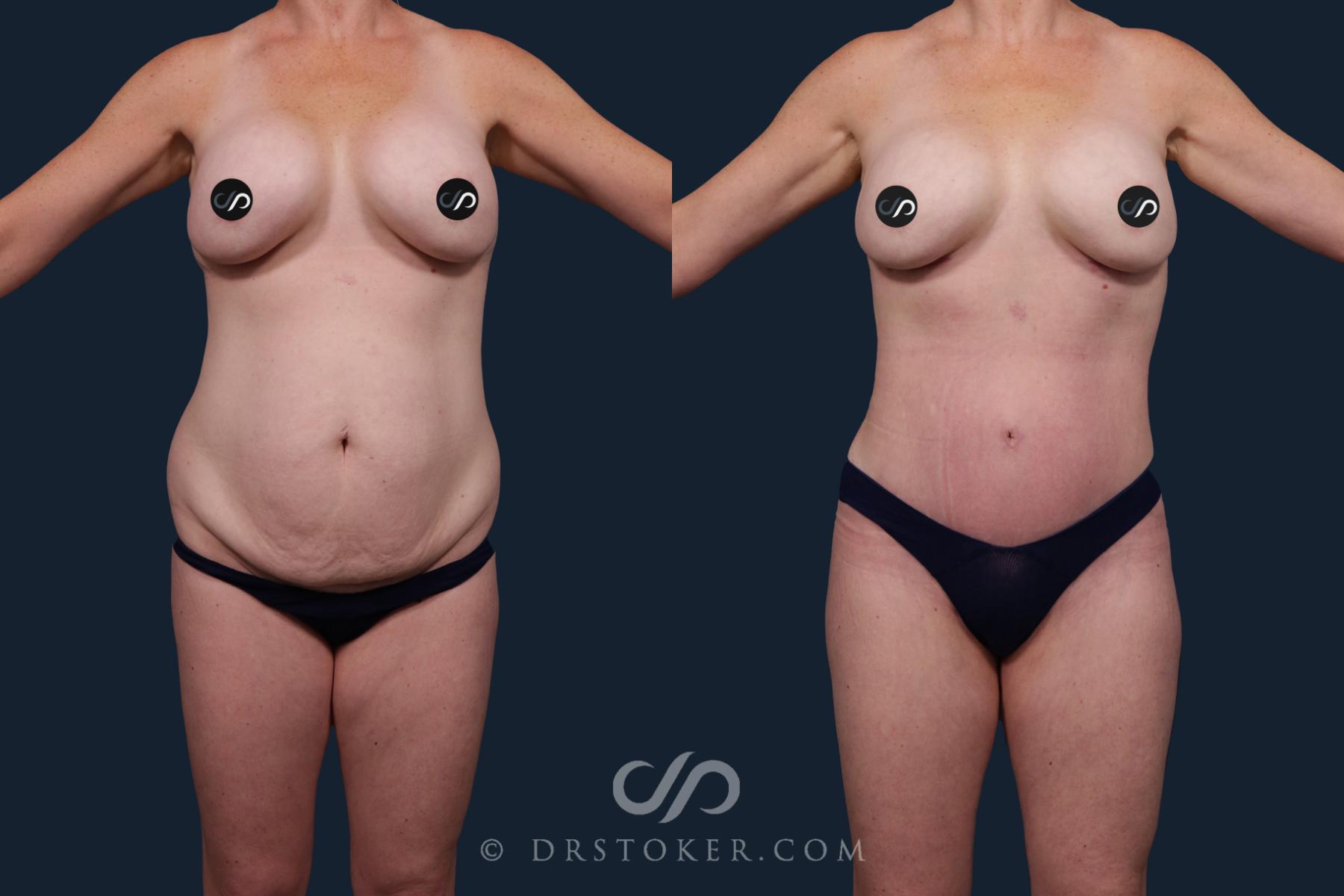 Before & After Mommy Makeover Case 2132 Front View in Los Angeles, CA