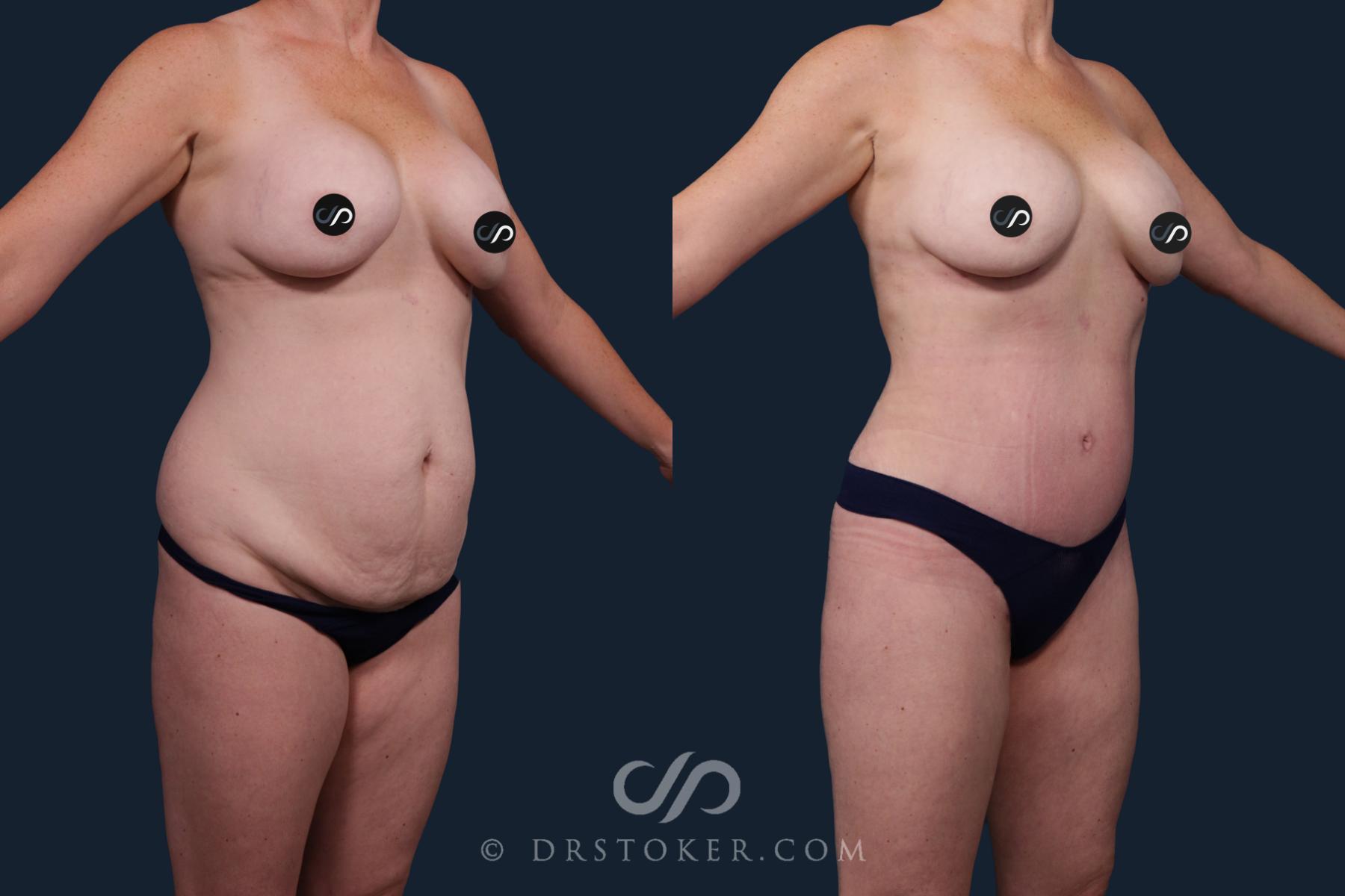 Before & After Mommy Makeover Case 2132 Left Oblique View in Los Angeles, CA