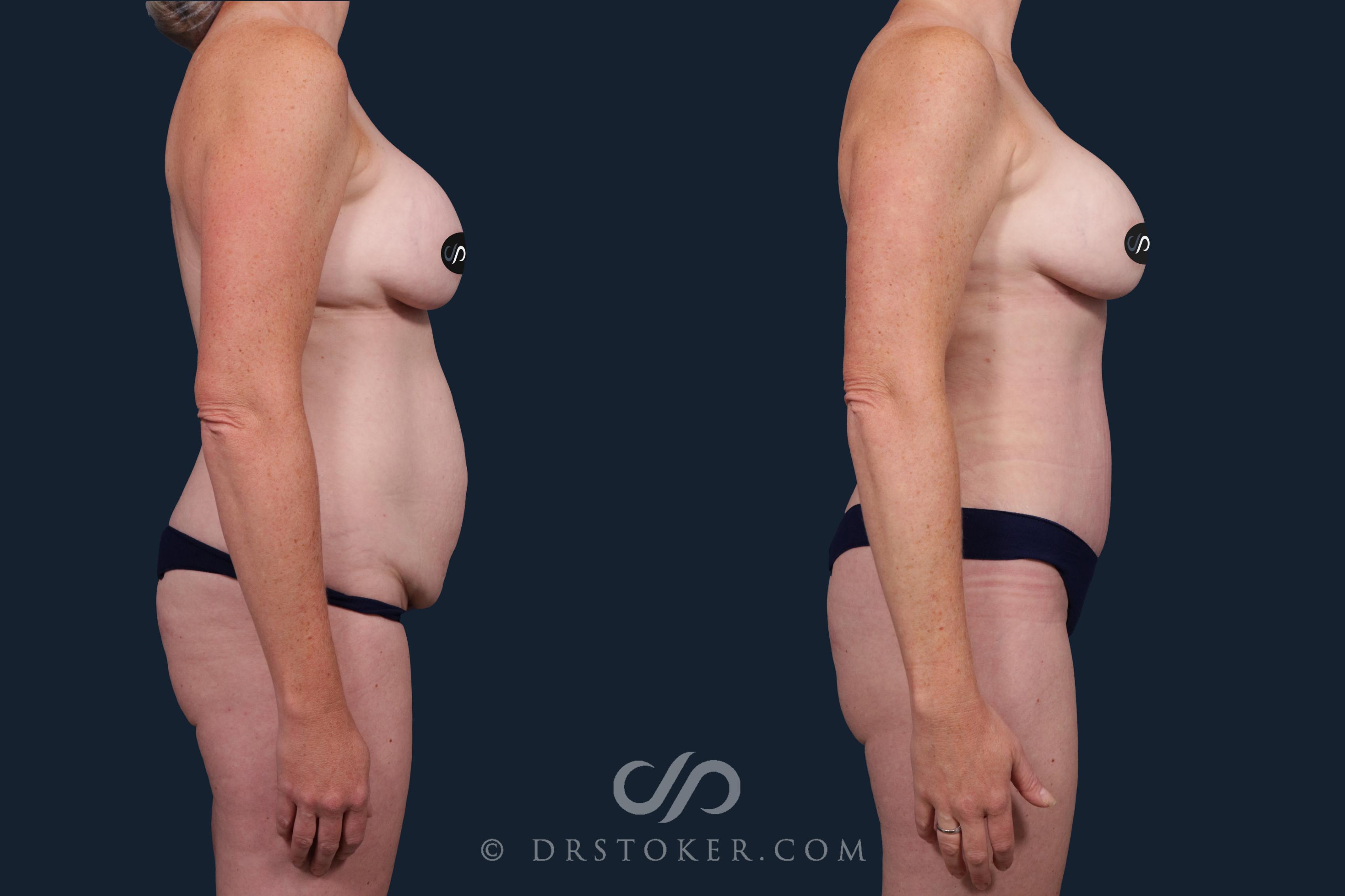 Before & After Mommy Makeover Case 2132 Right Side View in Los Angeles, CA