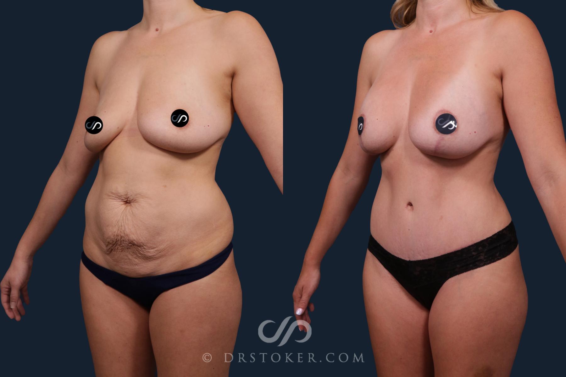 Before & After Mommy Makeover Case 2176 Left Oblique View in Los Angeles, CA
