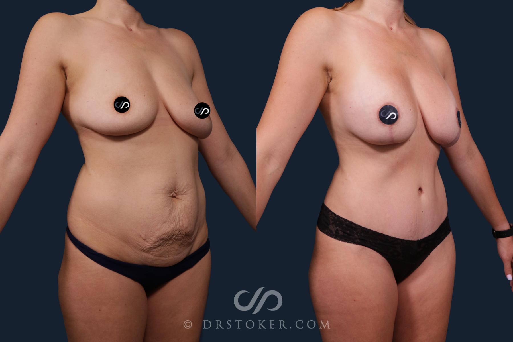 Before & After Mommy Makeover Case 2176 Right Oblique View in Los Angeles, CA