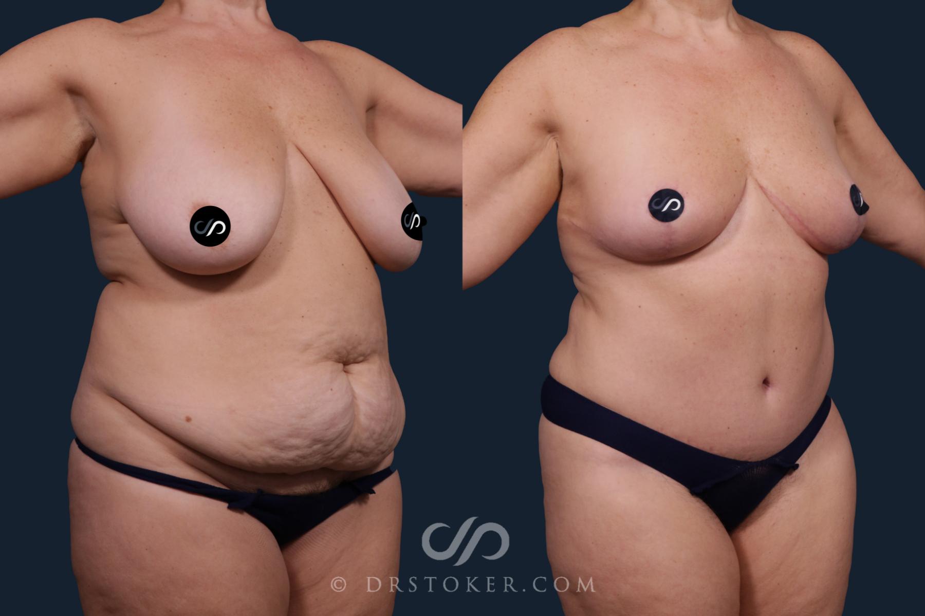 Before & After Mommy Makeover Case 2217 Right Oblique View in Los Angeles, CA