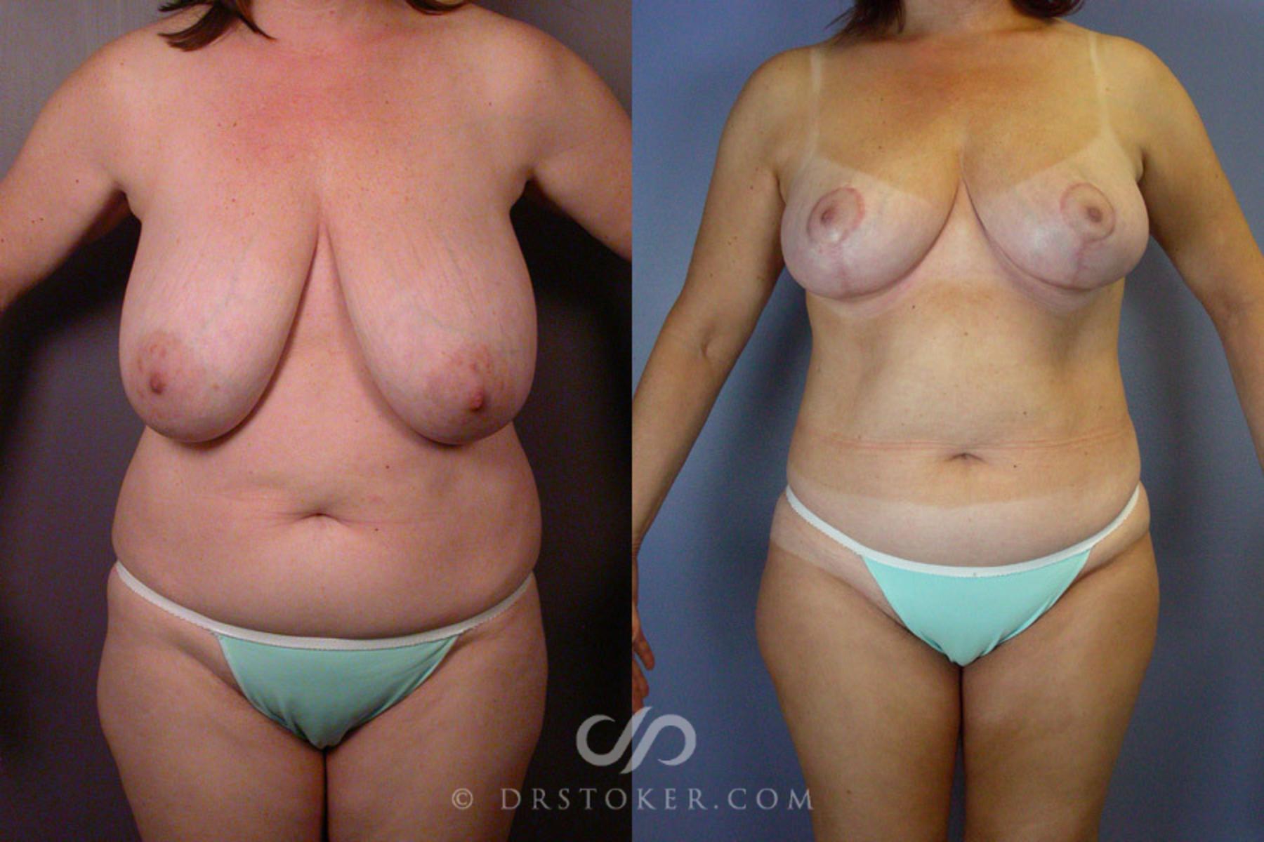 Before & After Breast Reduction (for Women) Case 236 View #1 View in Los Angeles, CA