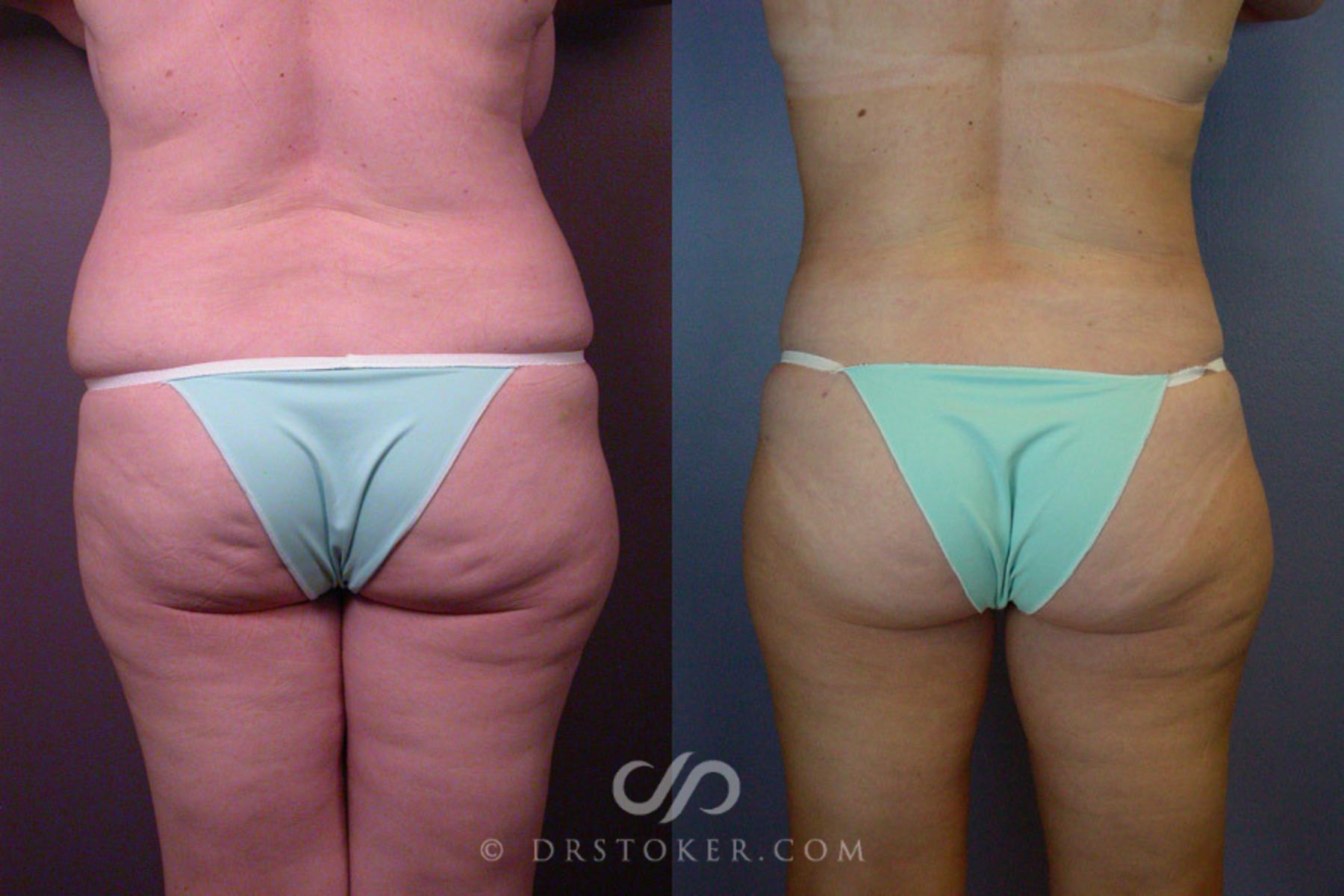 Before & After Breast Reduction (for Women) Case 236 View #3 View in Los Angeles, CA