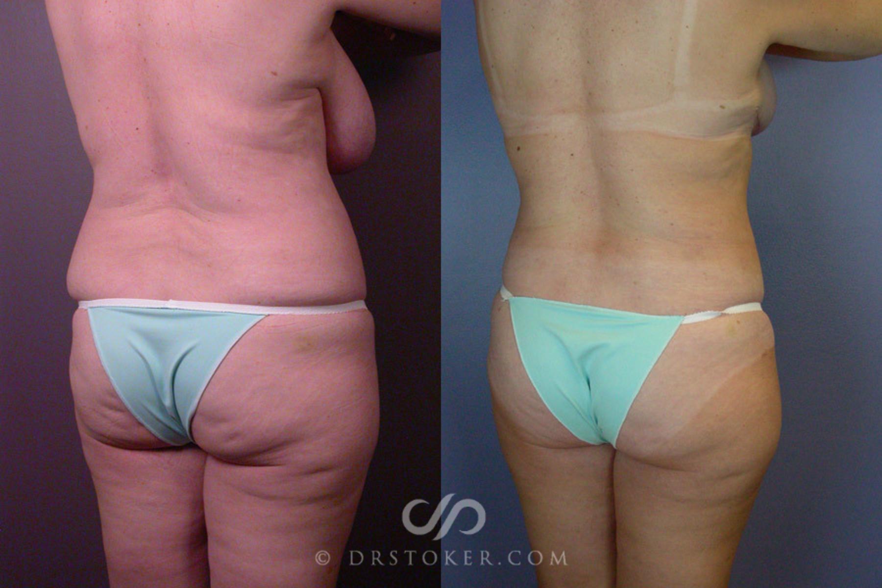 Before & After Breast Reduction (for Women) Case 236 View #4 View in Los Angeles, CA