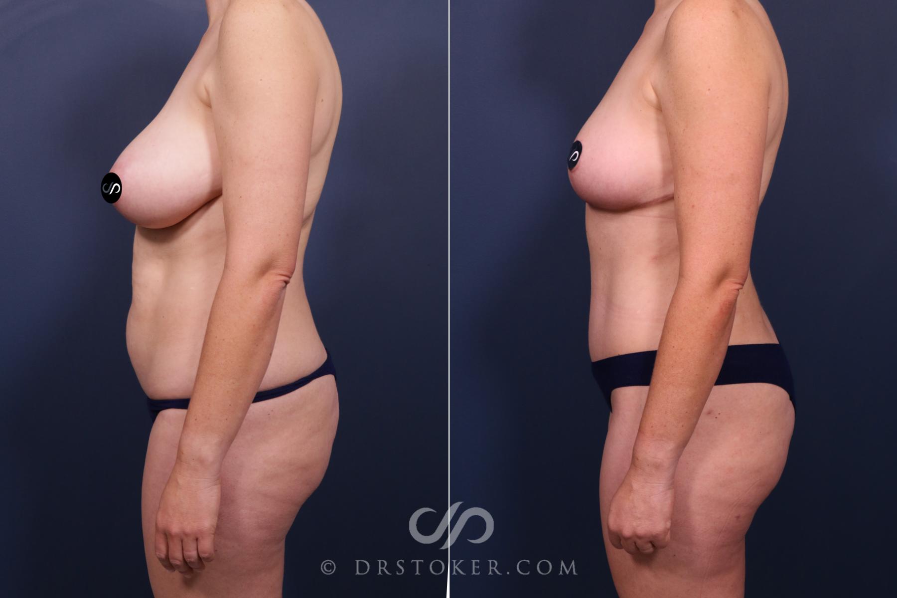 Before & After Mommy Makeover Case 2677 Left Side View in Los Angeles, CA
