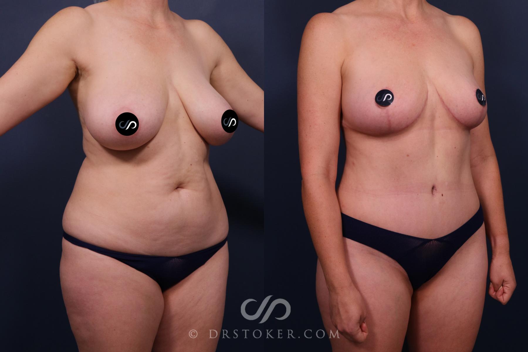 Before & After Mommy Makeover Case 2677 Right Oblique View in Los Angeles, CA