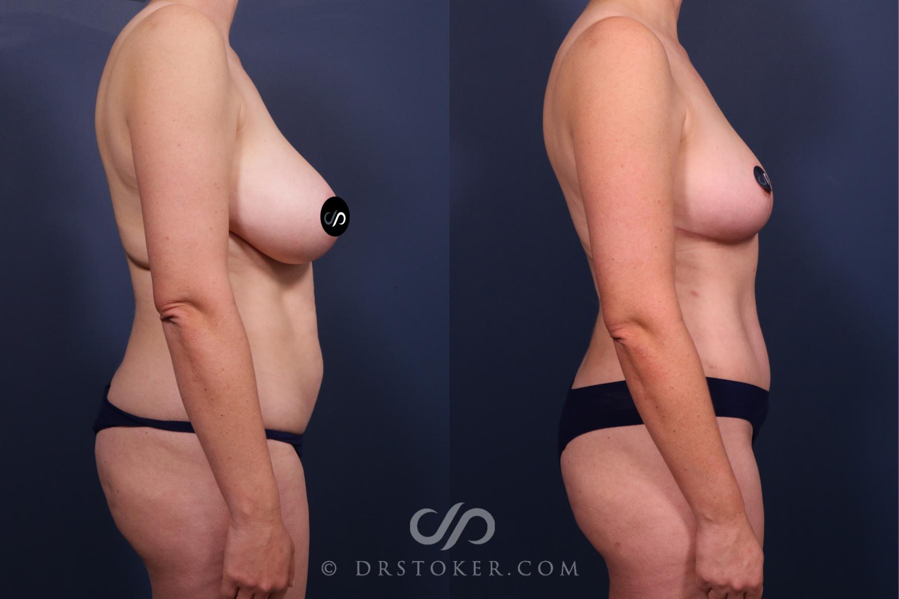 Before & After Mommy Makeover Case 2677 Right Side View in Los Angeles, CA