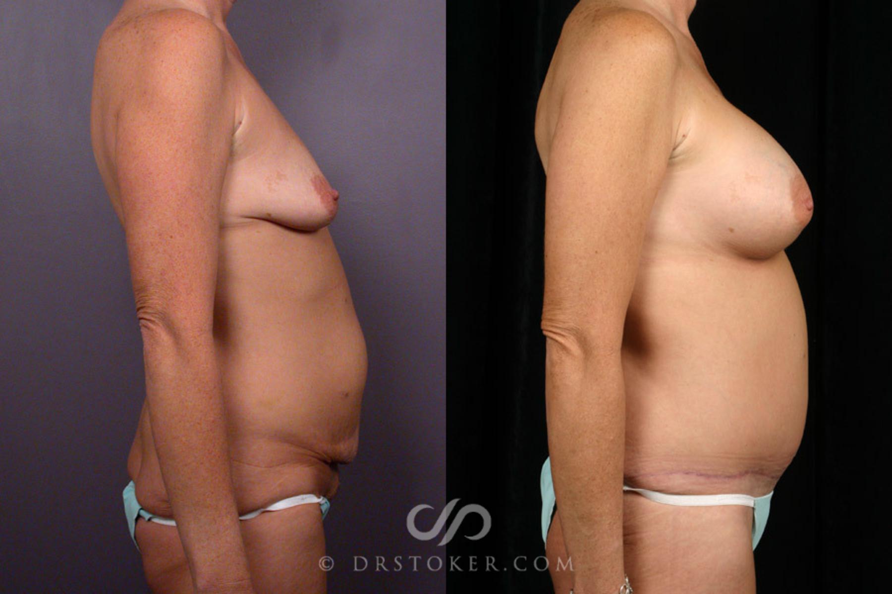 Before & After Tummy Tuck Case 318 View #4 View in Los Angeles, CA