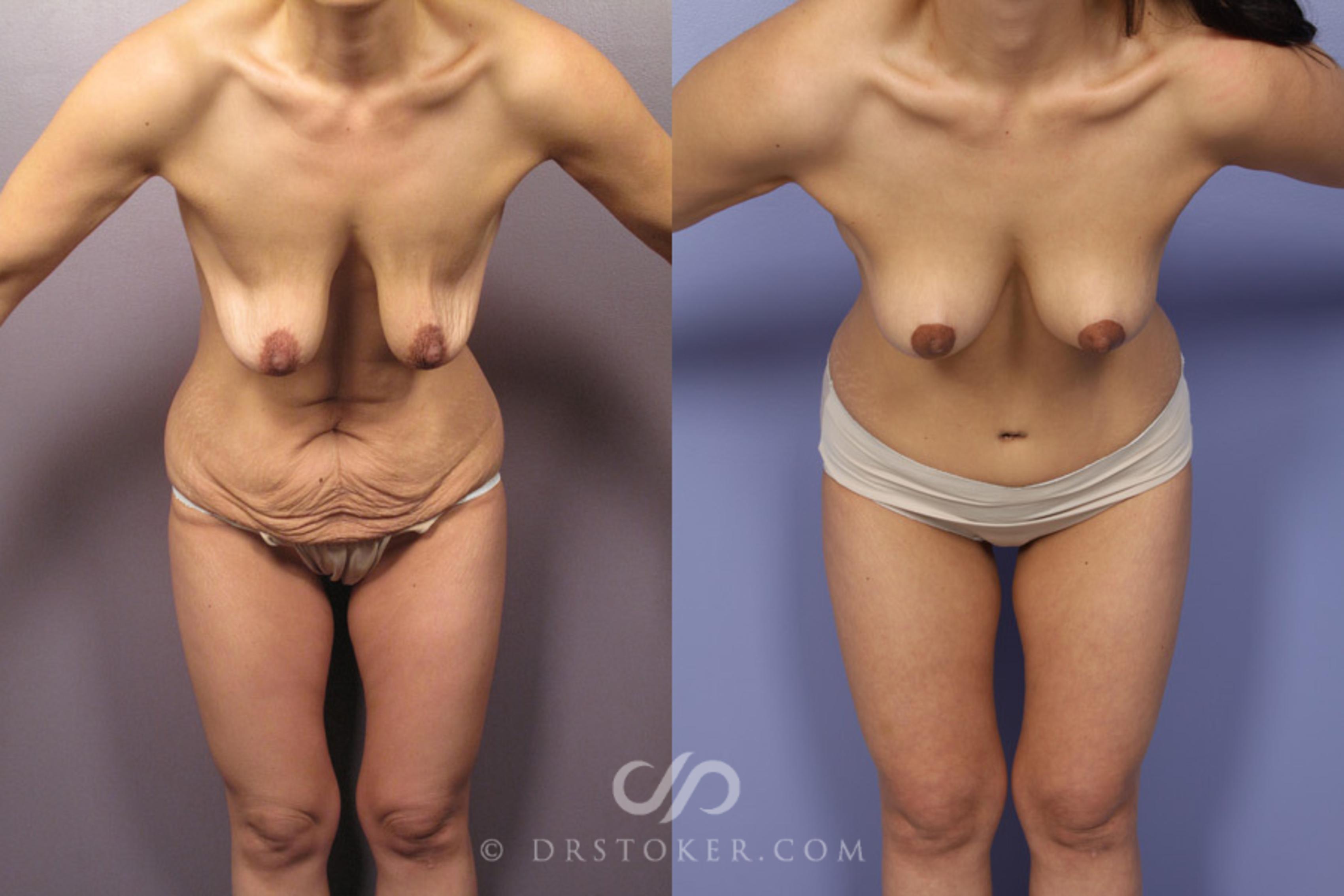 Before & After Tummy Tuck Case 349 View #1 View in Los Angeles, CA