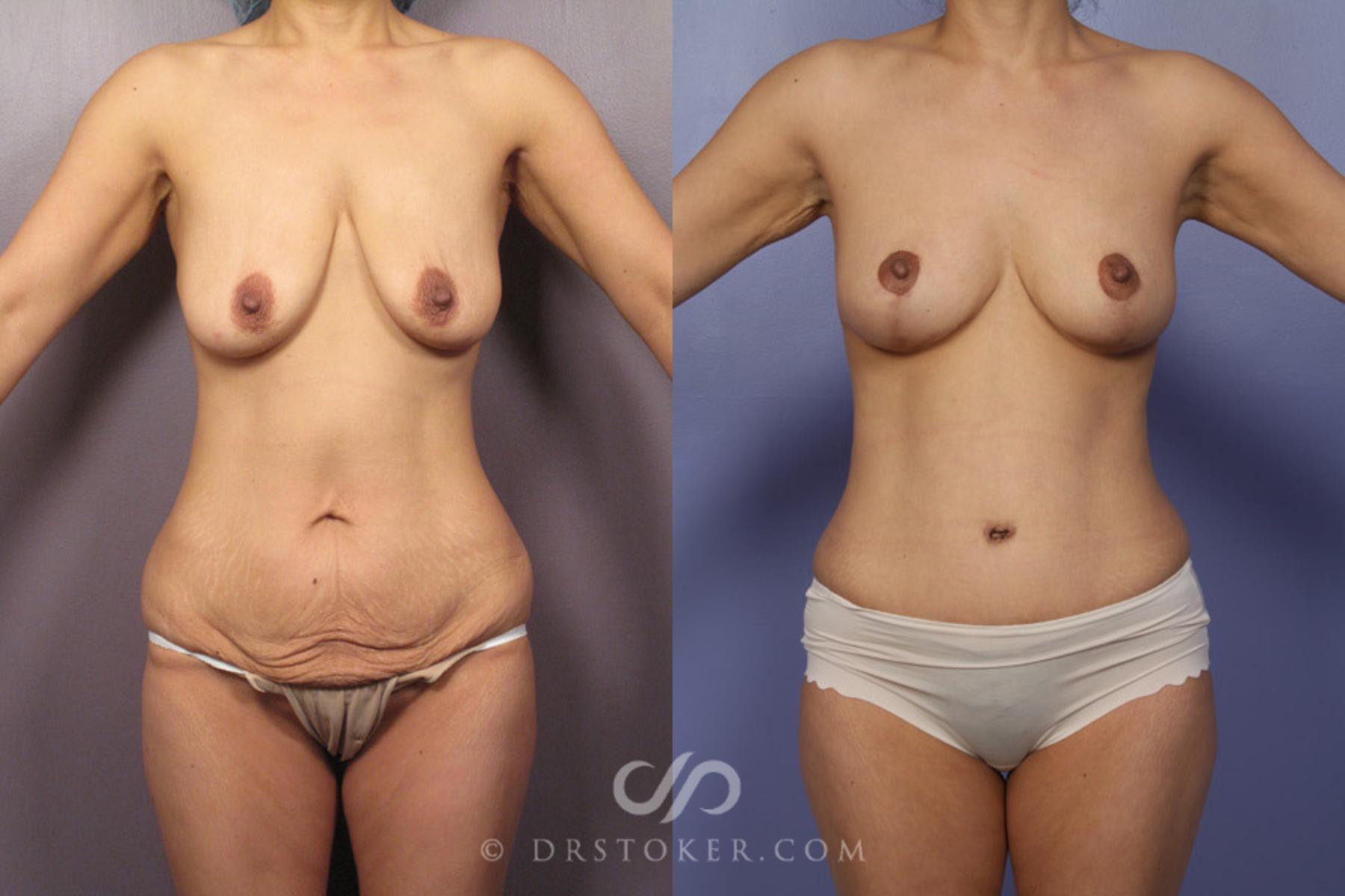 Before & After After Weight Loss Case 349 View #3 View in Los Angeles, CA