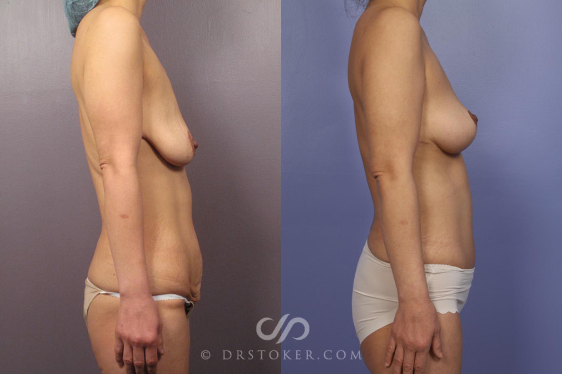 Before & After After Weight Loss Case 349 View #4 View in Los Angeles, CA