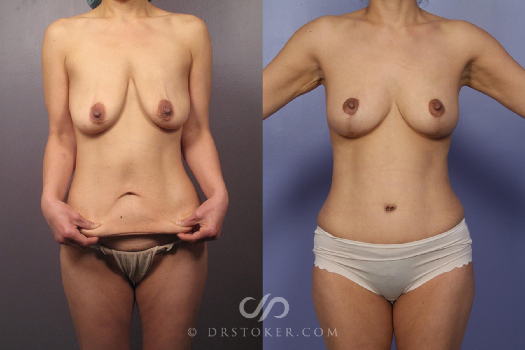 Before & After After Weight Loss Case 349 View #6 View in Los Angeles, CA