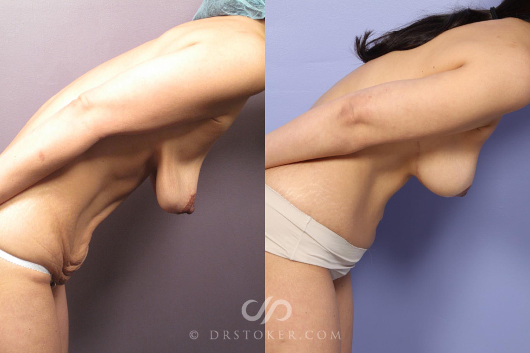 Before & After After Weight Loss Case 349 View #7 View in Los Angeles, CA