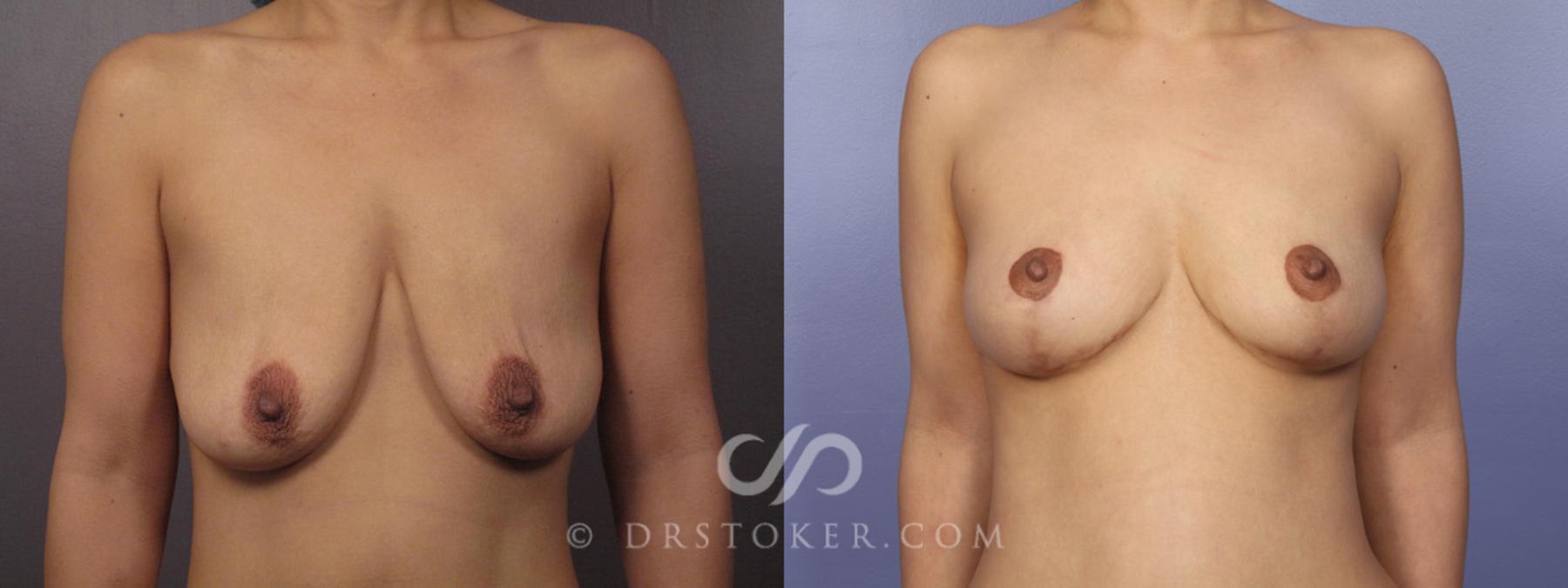 Before & After After Weight Loss Case 349 View #9 View in Los Angeles, CA