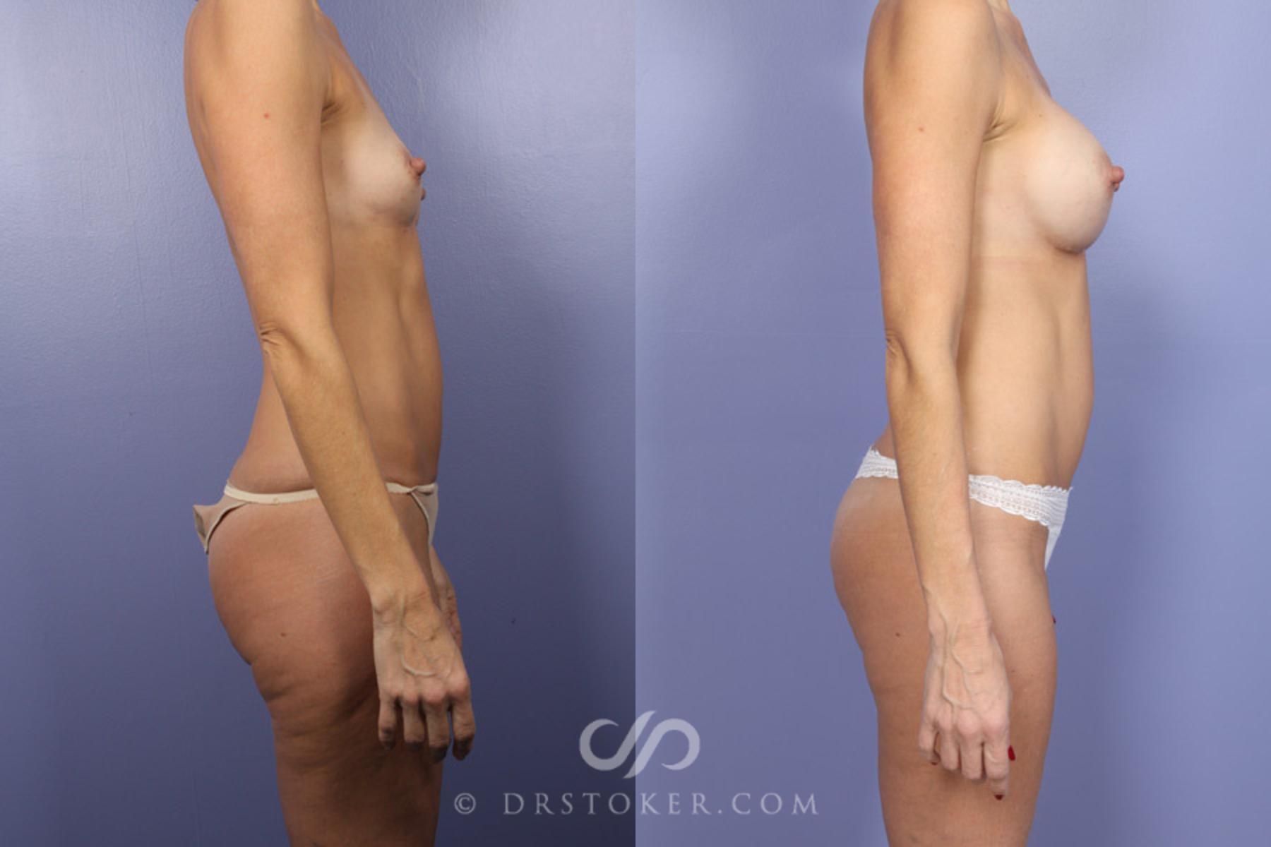 Before & After Tummy Tuck Case 372 View #4 View in Los Angeles, CA