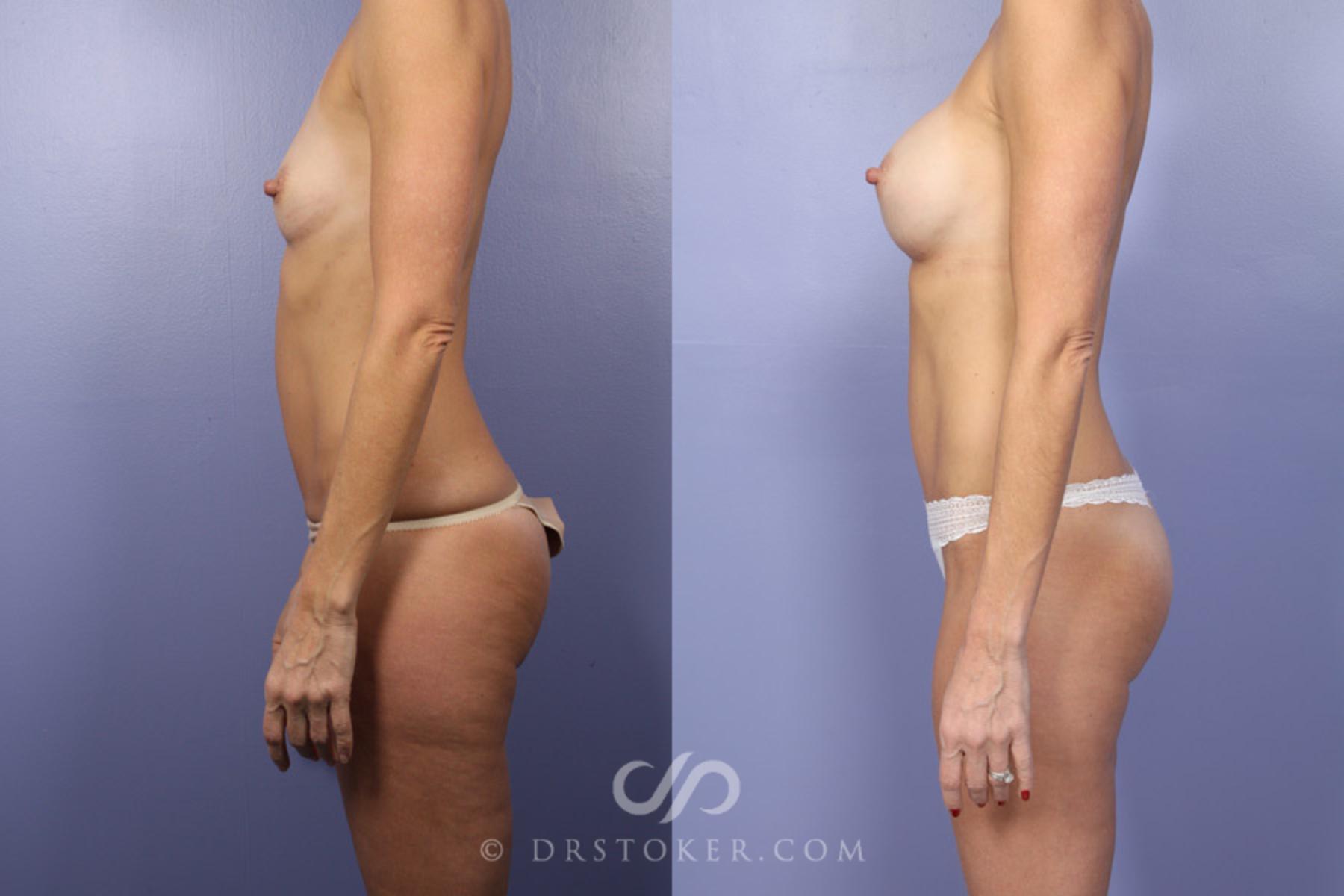 Before & After Tummy Tuck Case 372 View #5 View in Los Angeles, CA