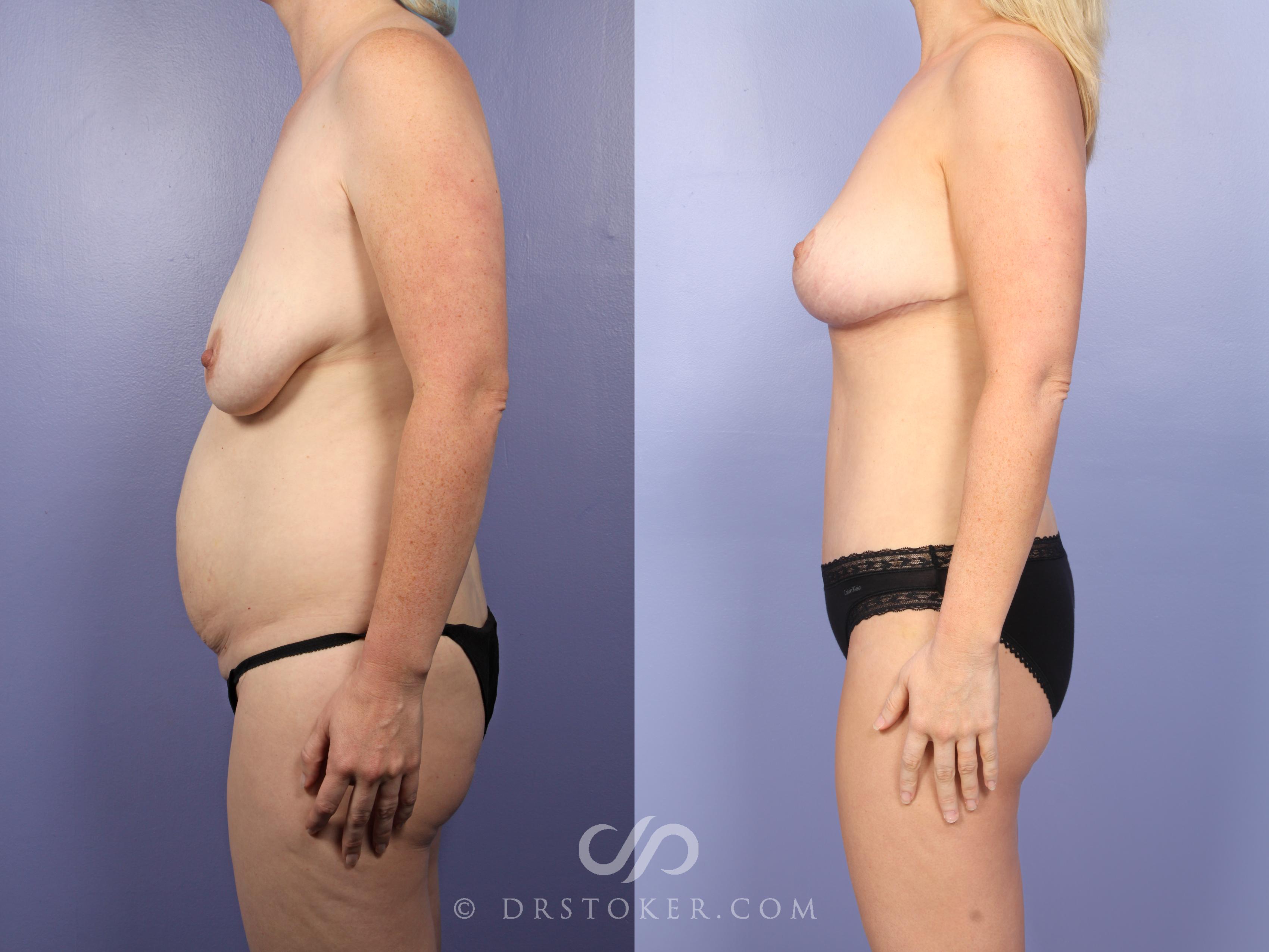 Before & After Mommy Makeover Case 498 View #3 View in Los Angeles, CA