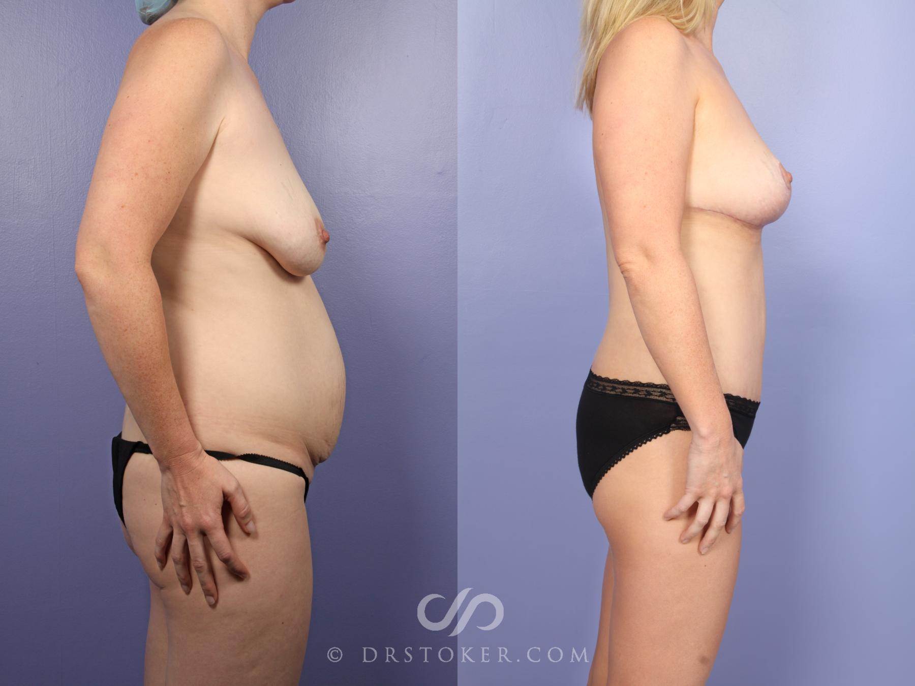 Before & After Mommy Makeover Case 498 View #5 View in Los Angeles, CA