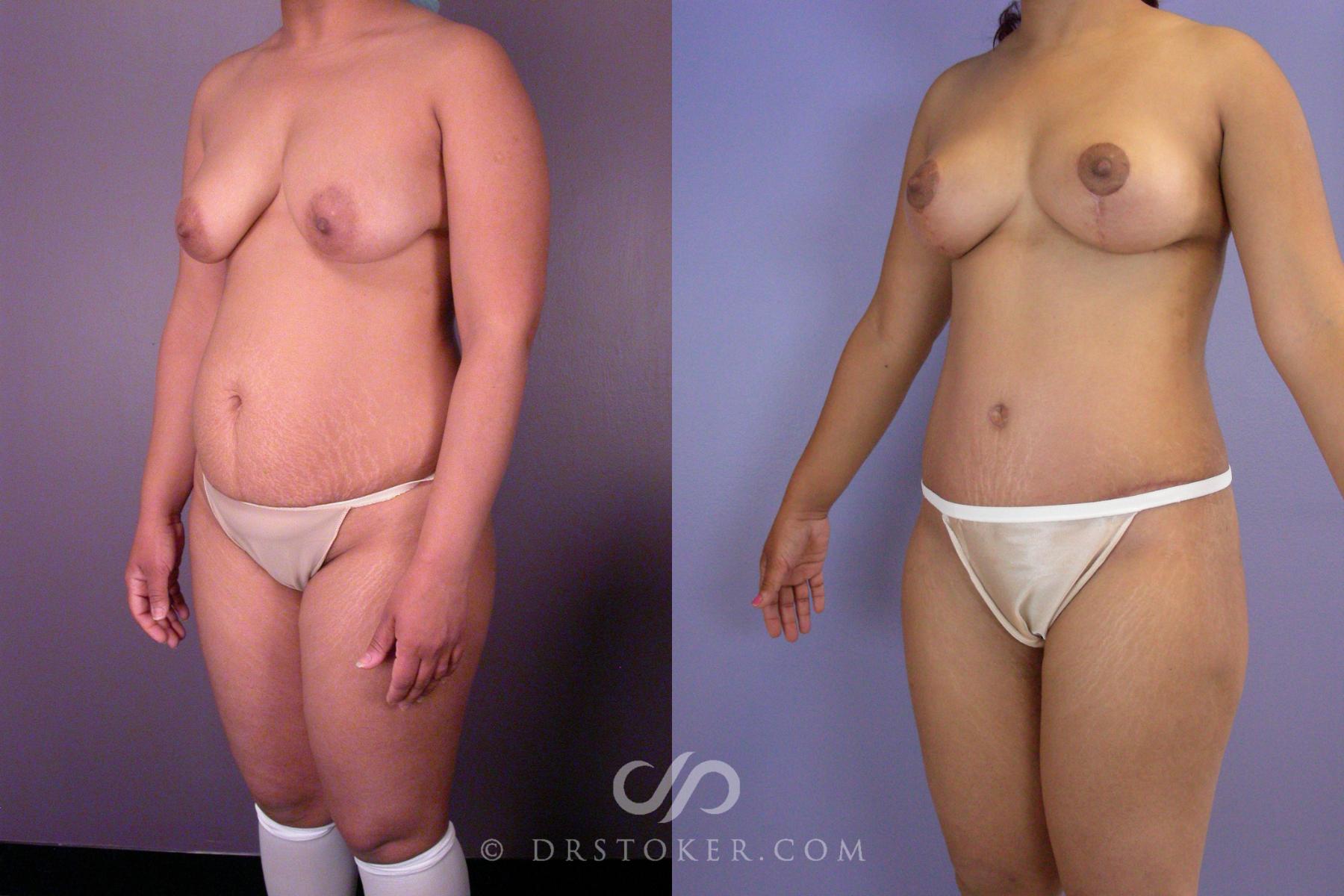 Before & After Mommy Makeover Case 518 View #4 View in Los Angeles, CA