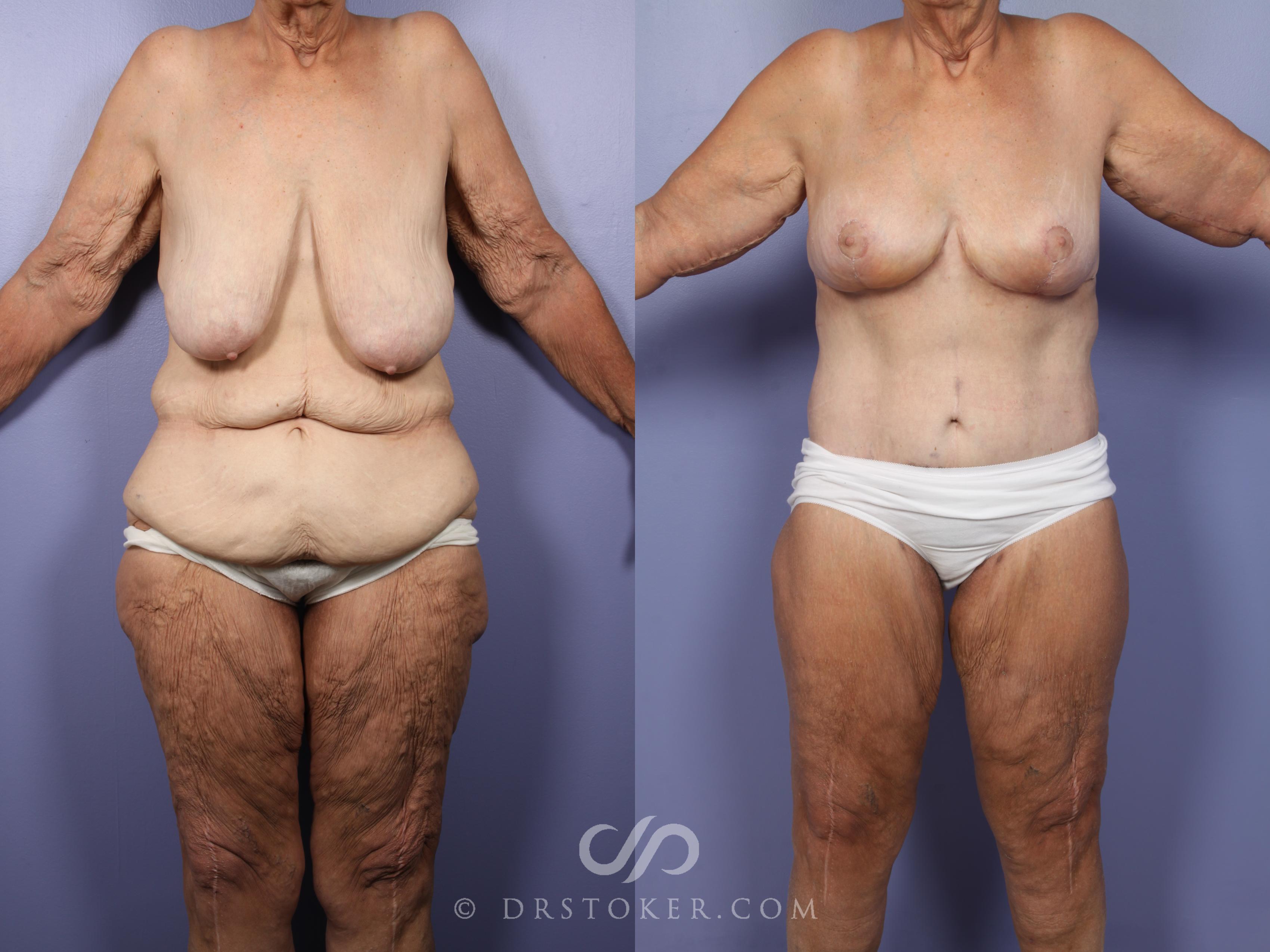 Before & After Tummy Tuck Case 519 View #1 View in Los Angeles, CA
