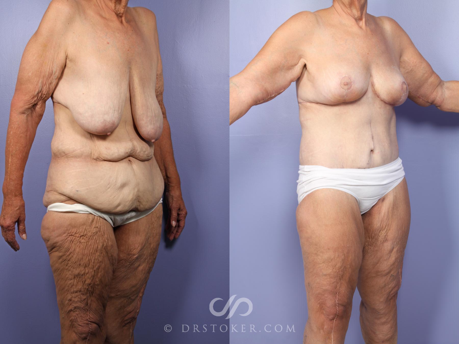 Before & After Tummy Tuck Case 519 View #2 View in Los Angeles, CA