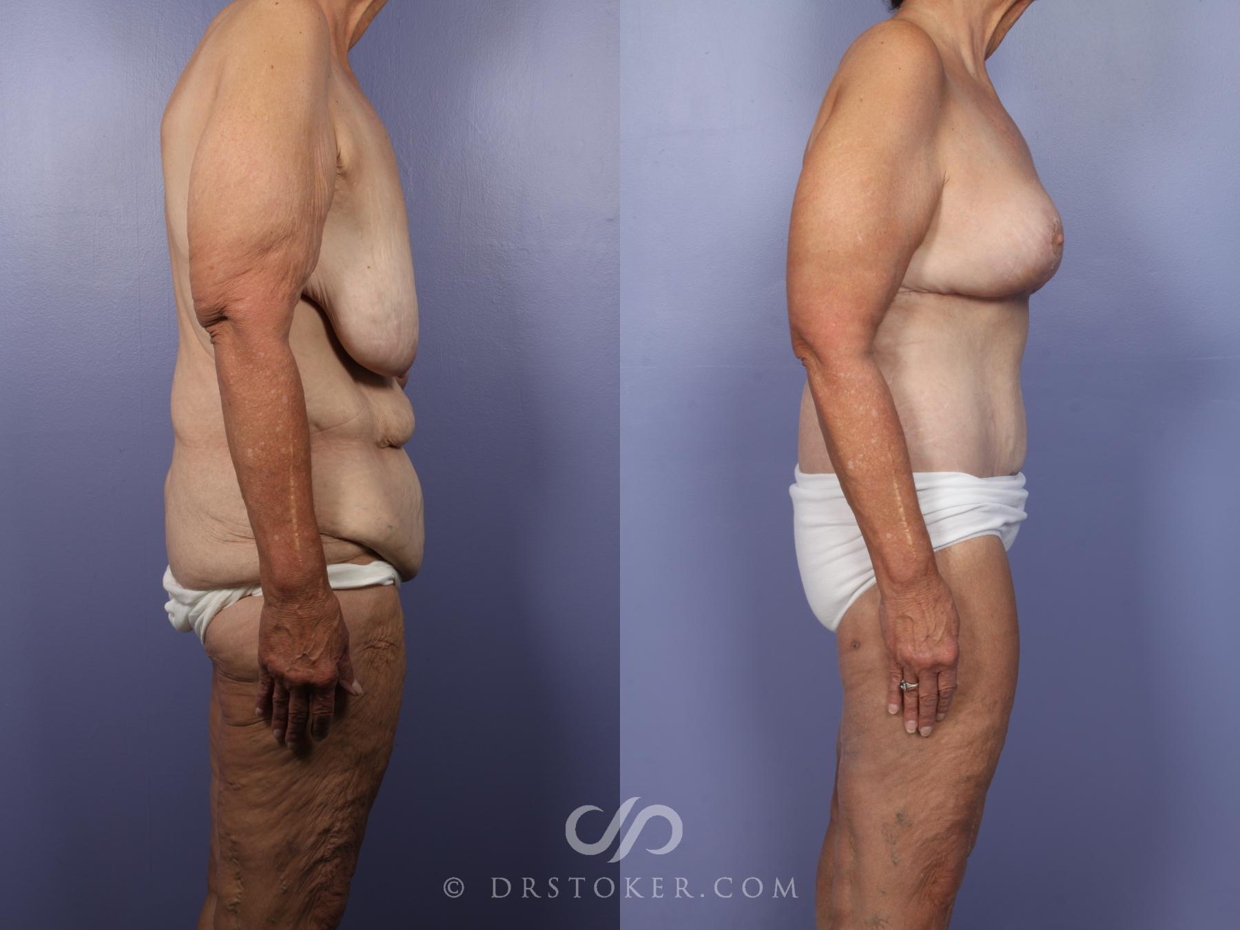 Before & After Breast Lift Case 519 View #3 View in Los Angeles, CA