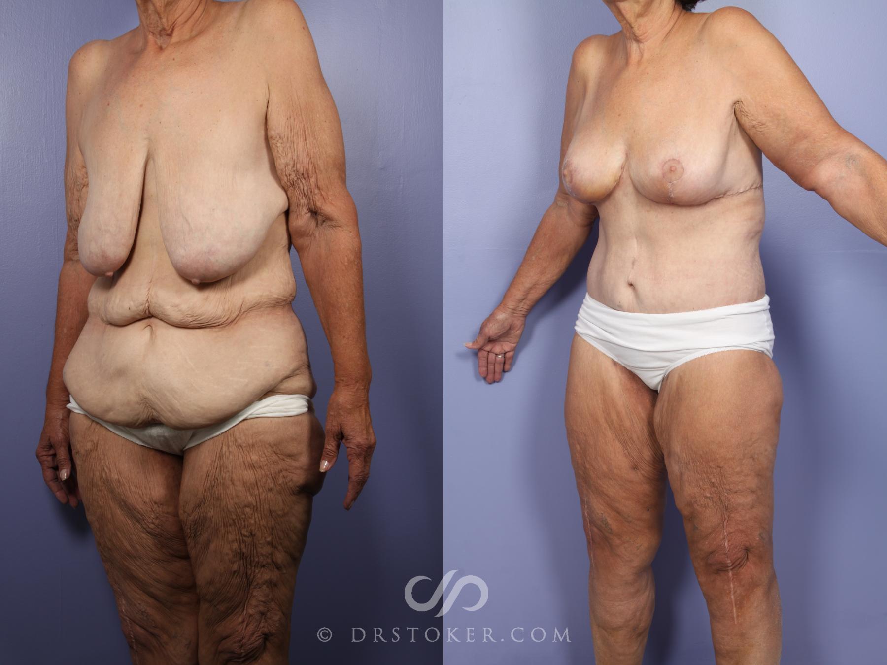 Before & After Breast Lift Case 519 View #4 View in Los Angeles, CA