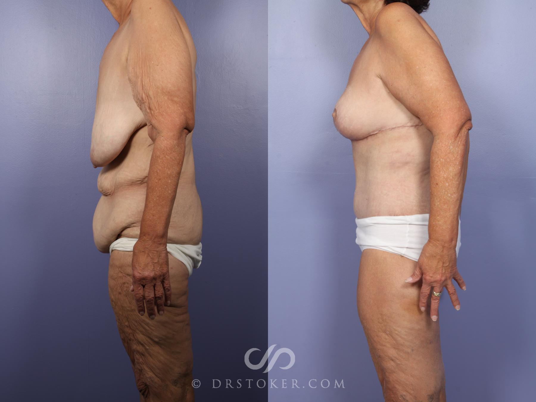 Before & After Body Lift Case 519 View #5 View in Los Angeles, CA