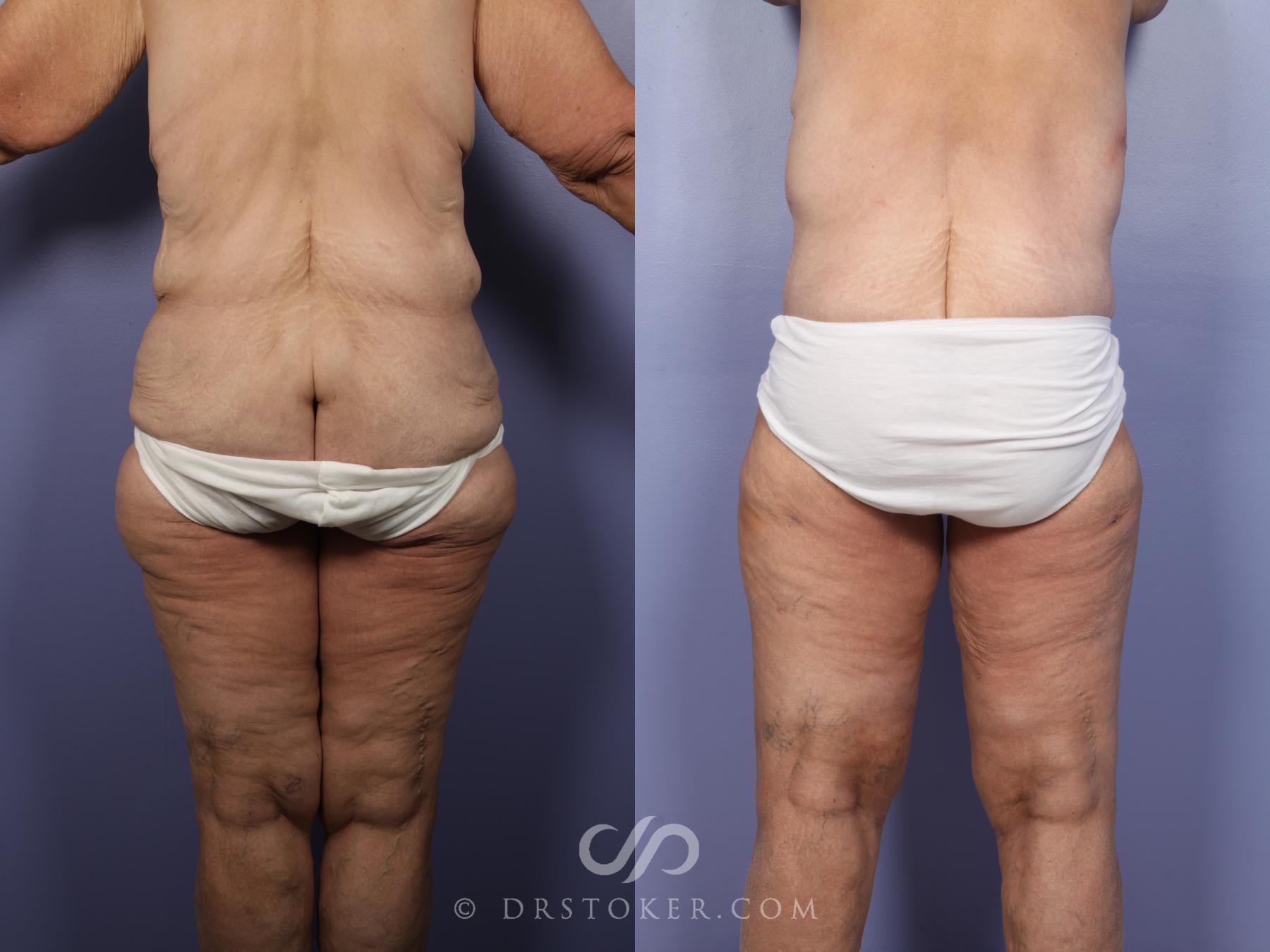 Before & After Body Lift Case 519 View #7 View in Los Angeles, CA
