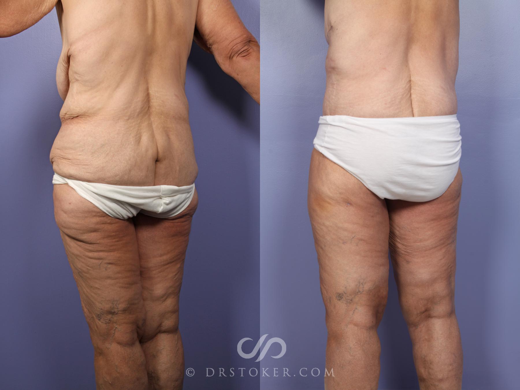 Before & After Tummy Tuck Case 519 View #8 View in Los Angeles, CA