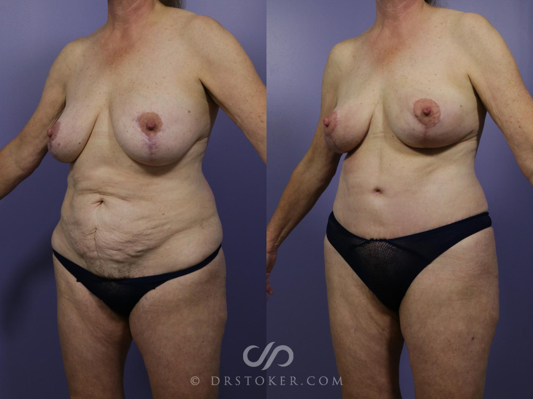 Before & After Mommy Makeover Case 730 View #3 View in Los Angeles, CA