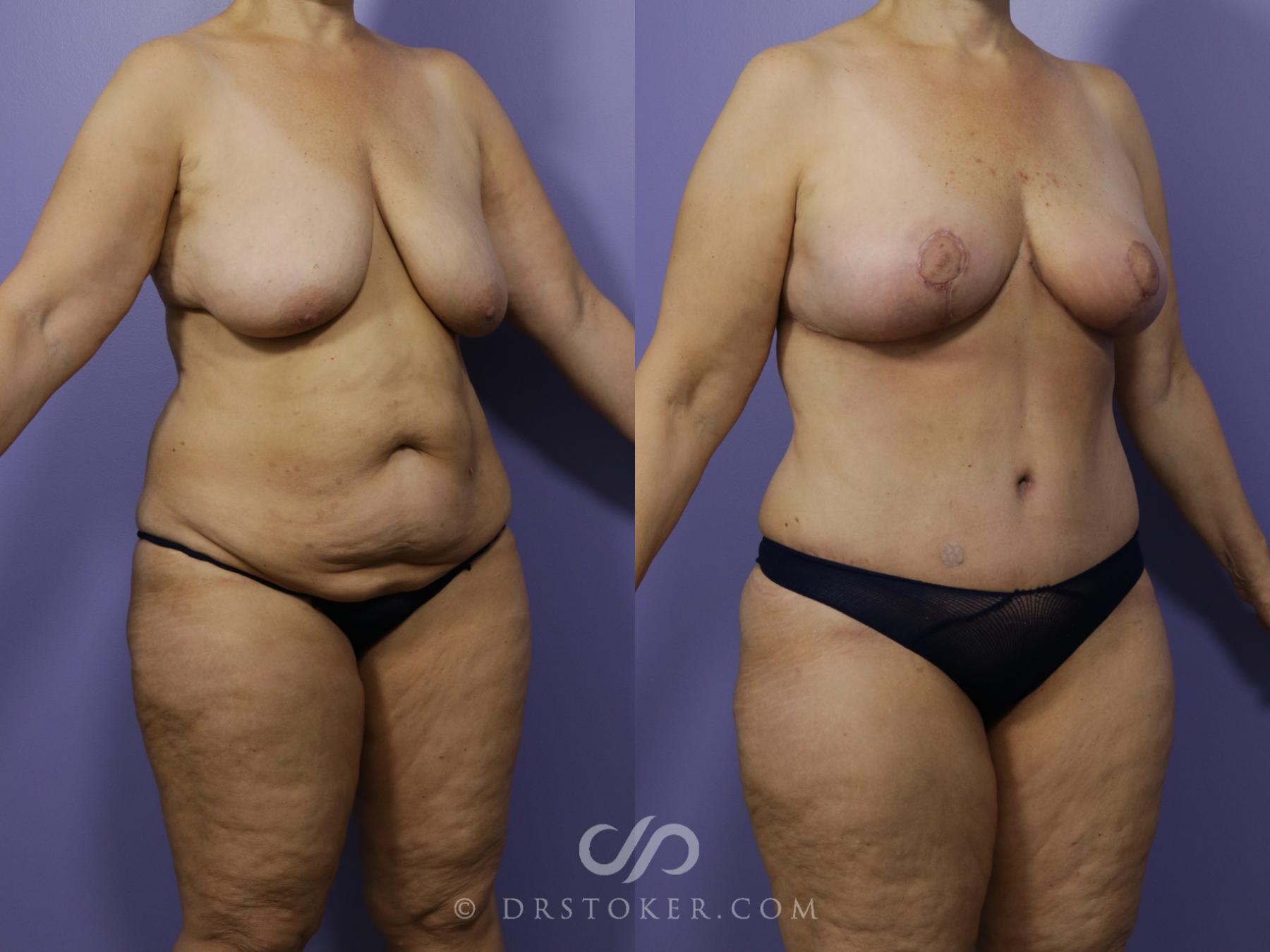 Before & After Mommy Makeover Case 731 View #2 View in Los Angeles, CA