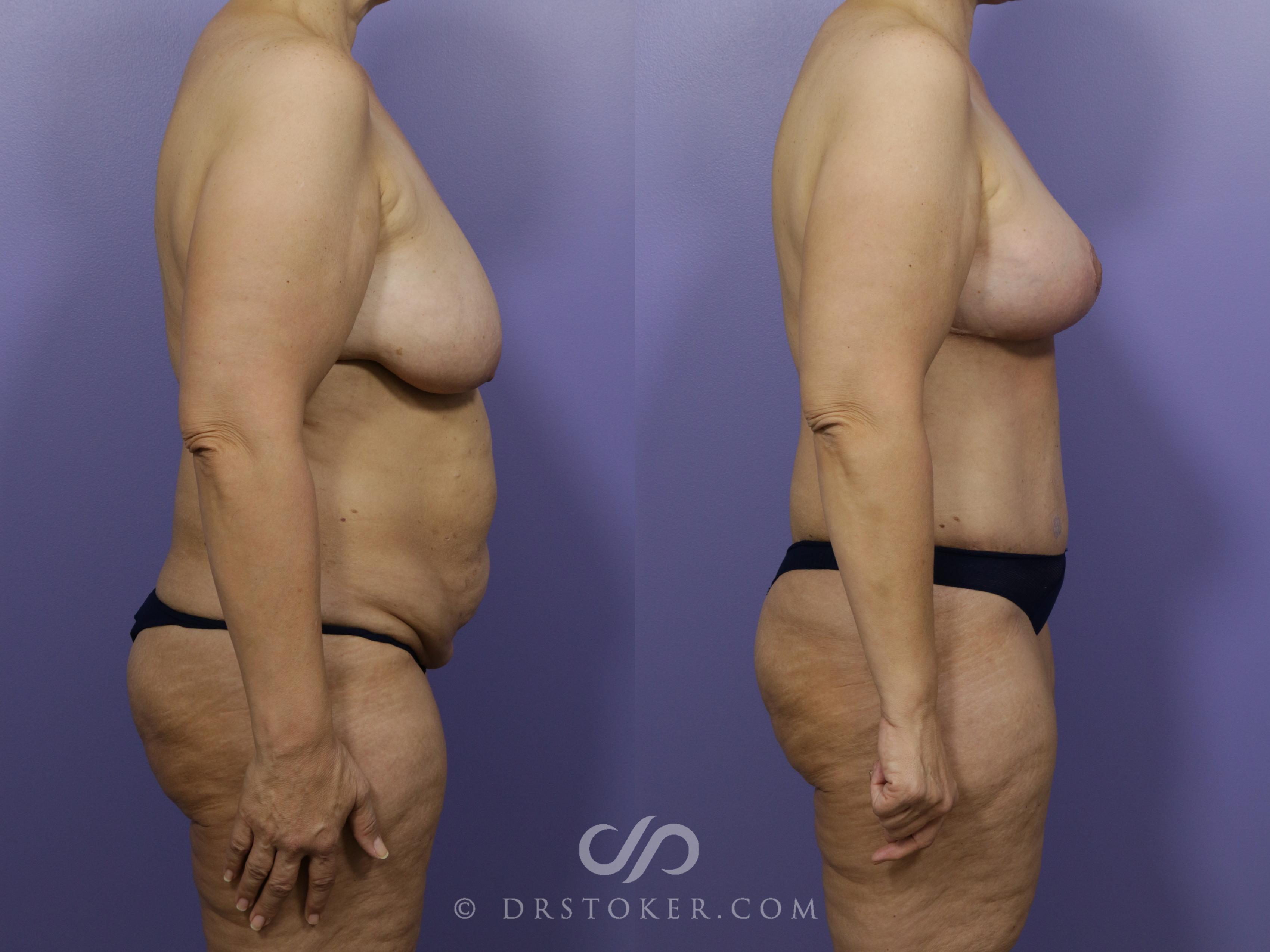 Before & After Mommy Makeover Case 731 View #3 View in Los Angeles, CA