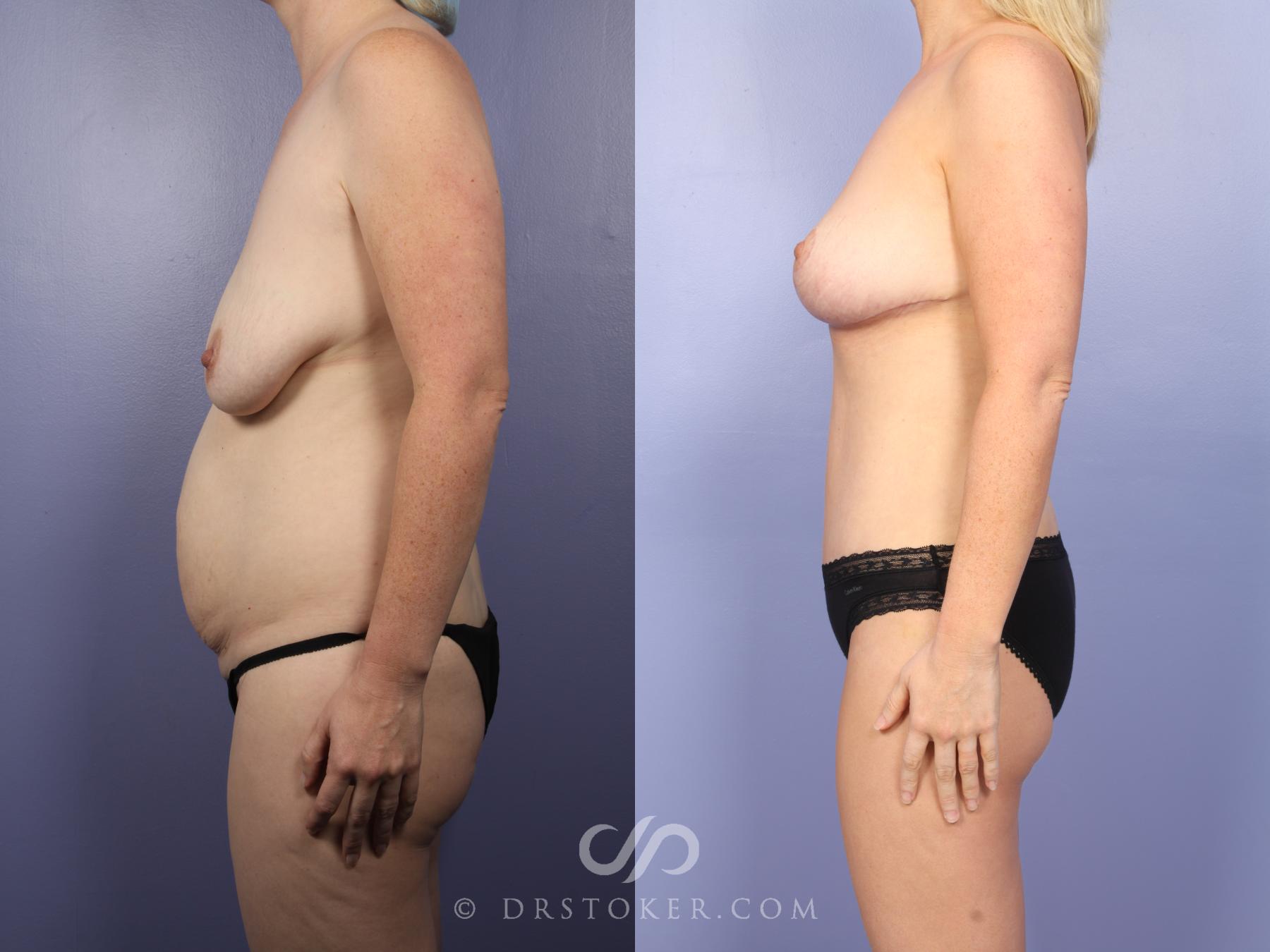 Before & After Mommy Makeover Case 732 View #3 View in Los Angeles, CA