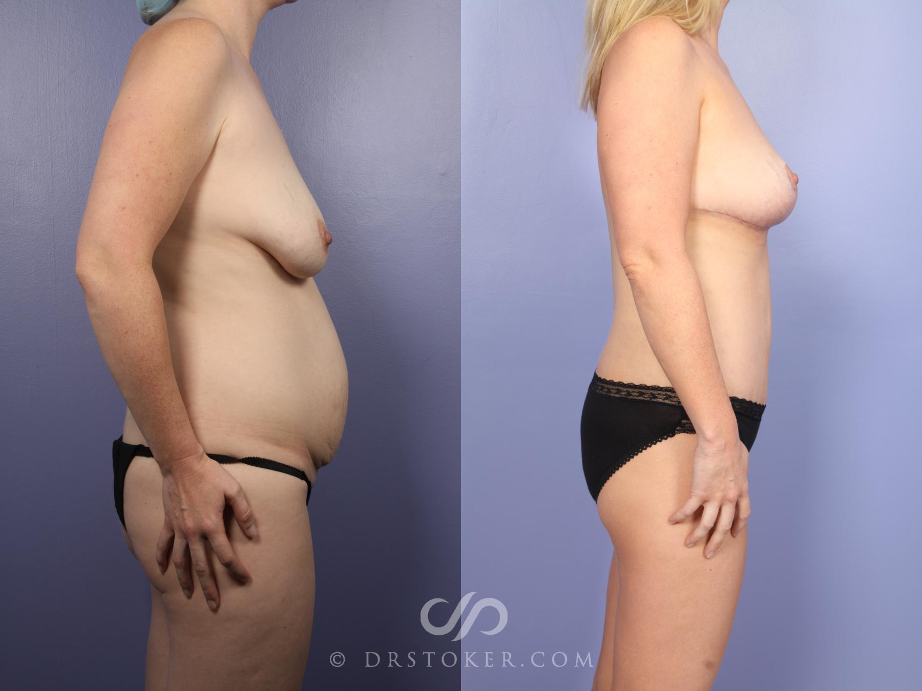 Before & After Mommy Makeover Case 732 View #5 View in Los Angeles, CA